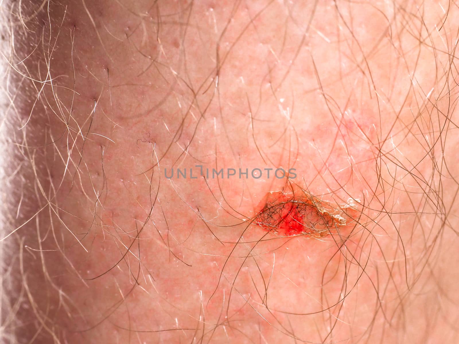 Person with injury on skin under hair