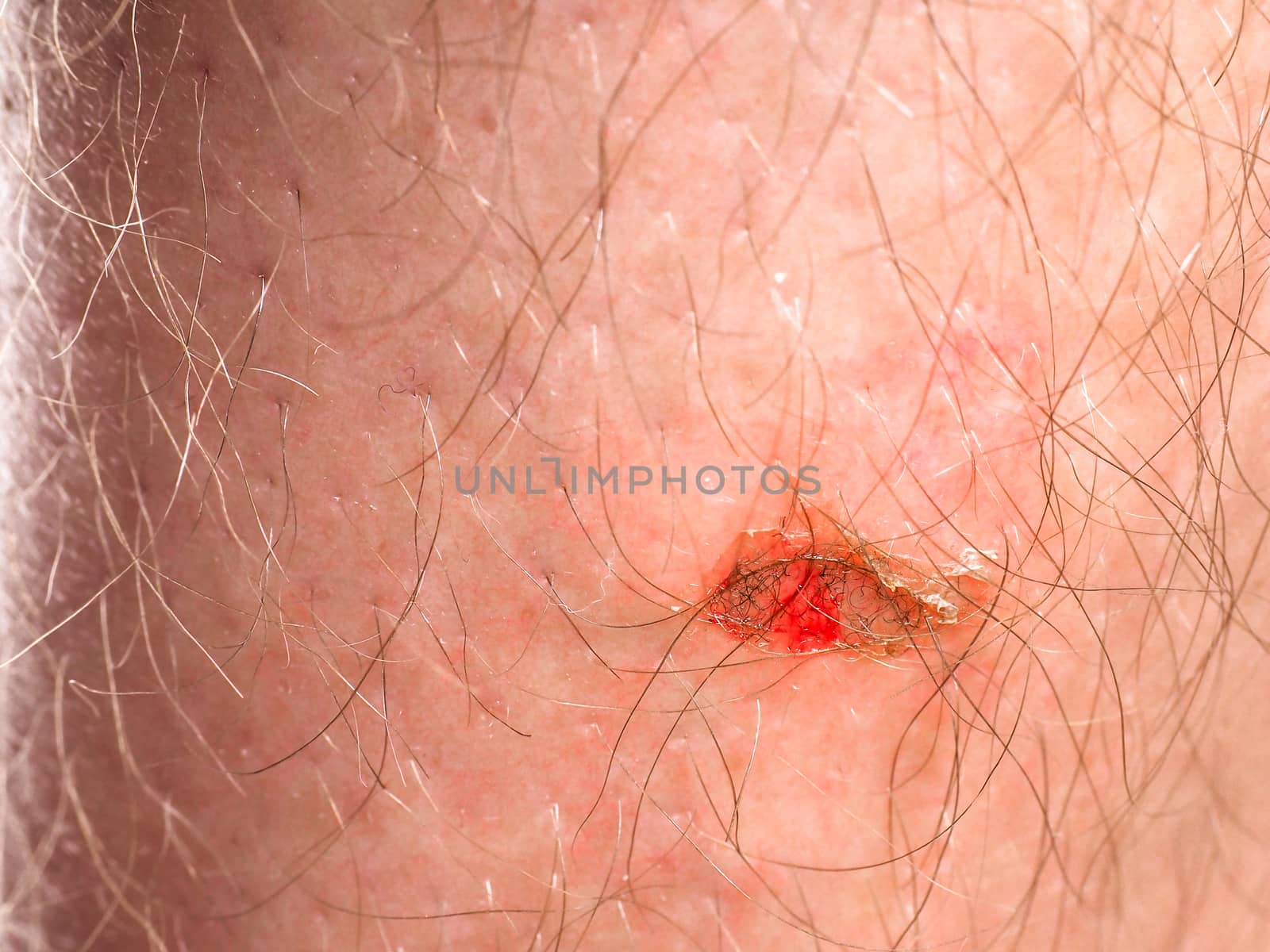 Person with injury on skin under hair