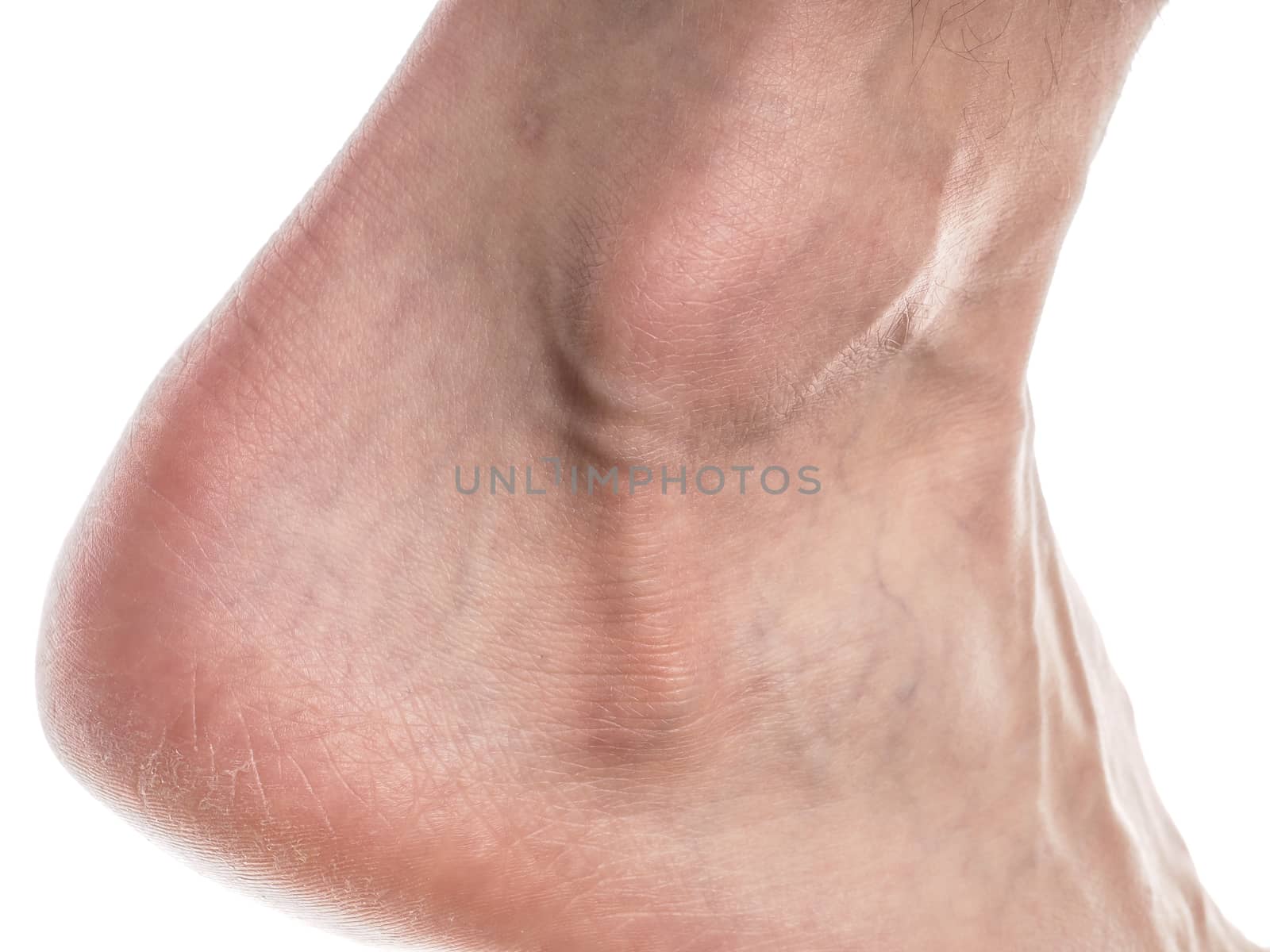 Closeup of a male ankle with dry skin on heal towards white
