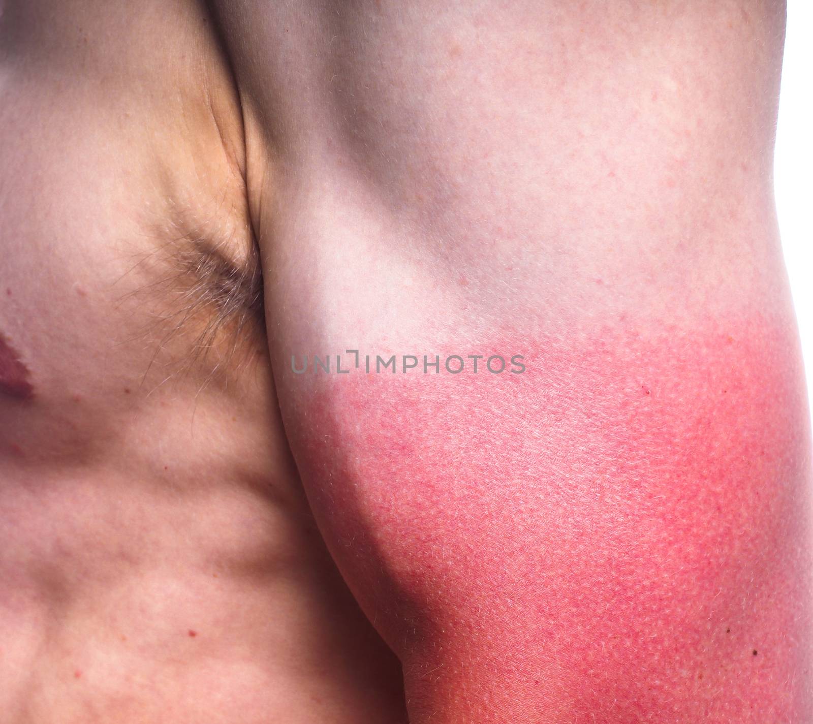 closeup of male with heavy sunburn on biceps