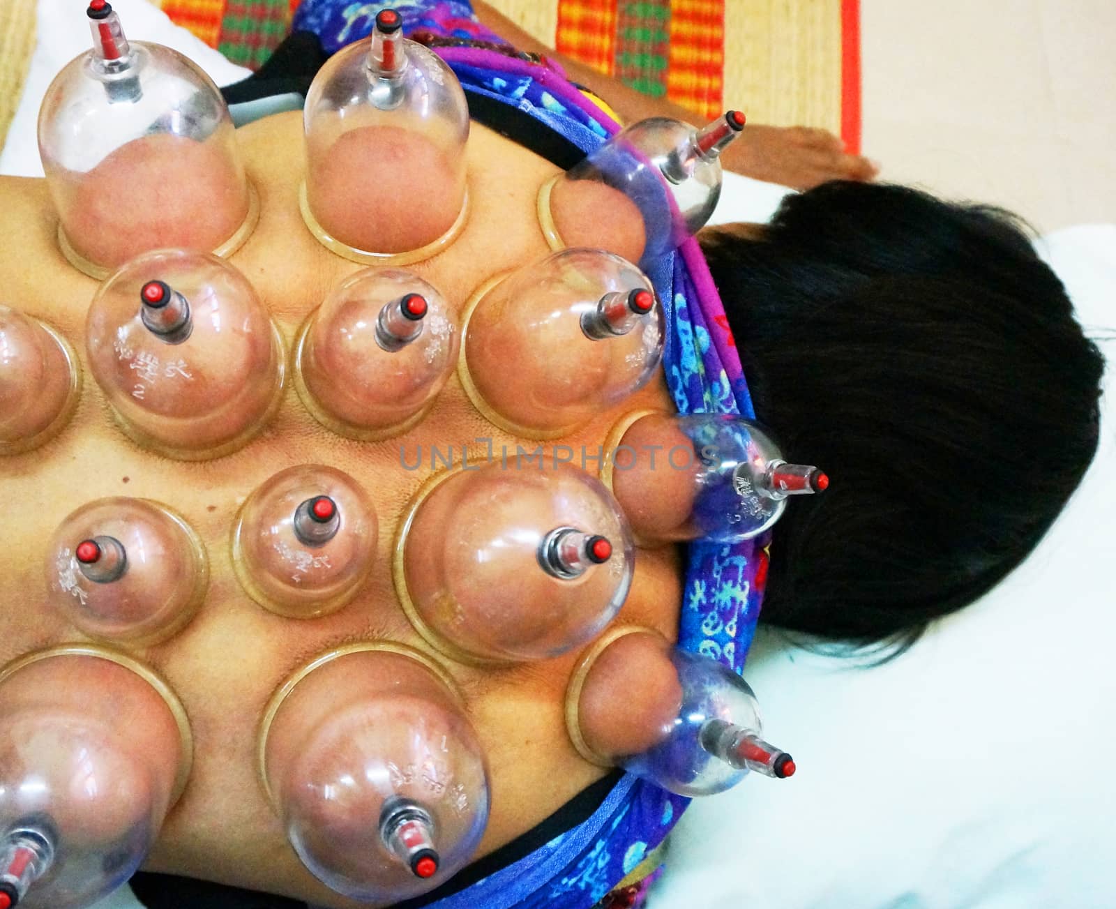 Cupping therapy is an ancient Chinese form of alternative medicine in which a local suction is created on the skin.