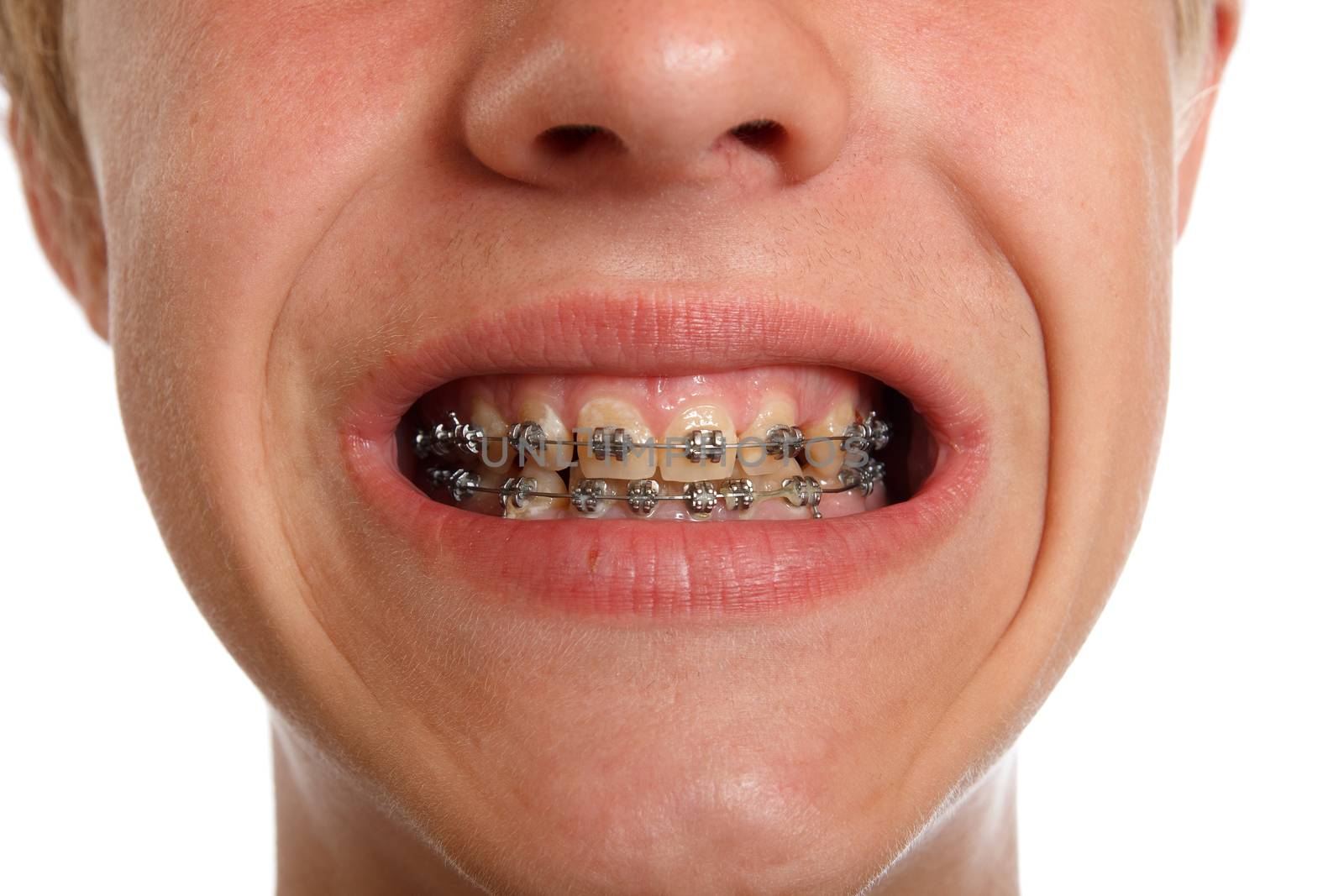 a set of teeth braces on boys teeth