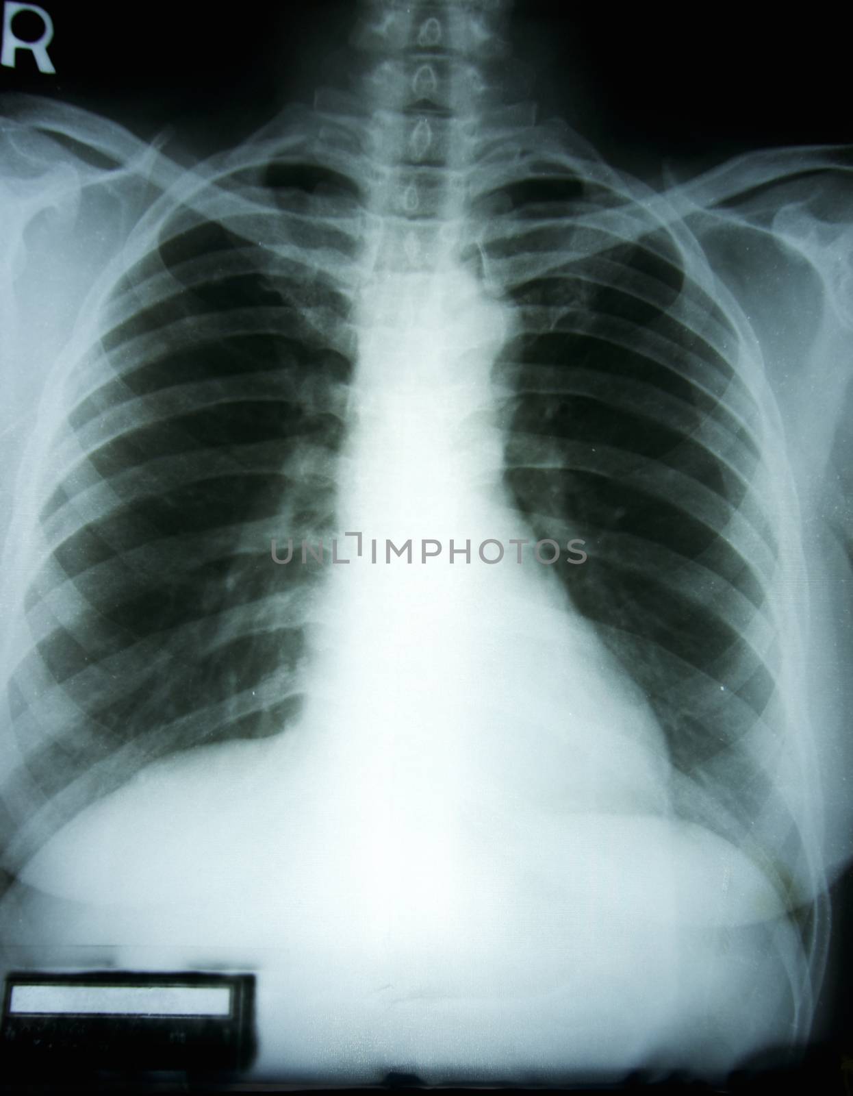 X-ray film of woman chest by eaglesky