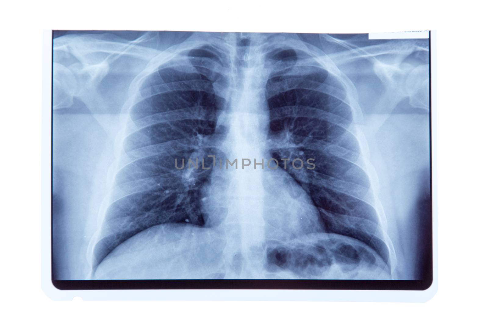 Lung radiography x-ray result, isolated on white background 