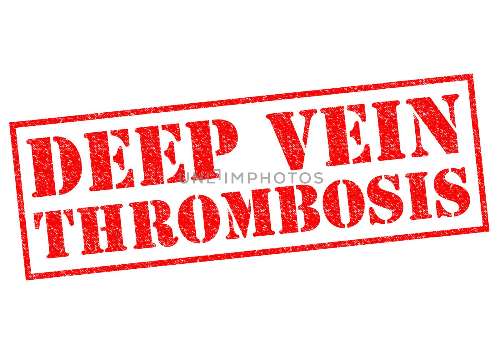 DEEP VEIN THROMBOSIS by chrisdorney