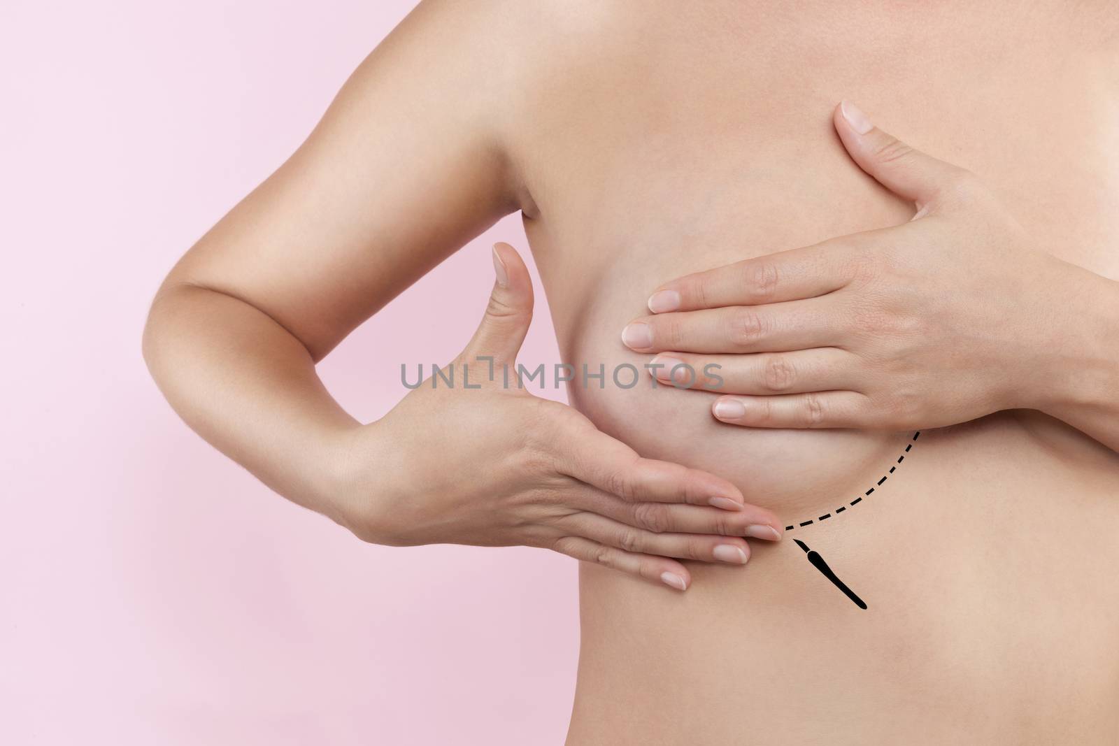 Breast augmentation. Plastic surgery and Aesthetic medicine. Beautiful woman gently touching her breast with marked dotted line ready for surgery. Breast augmentation.