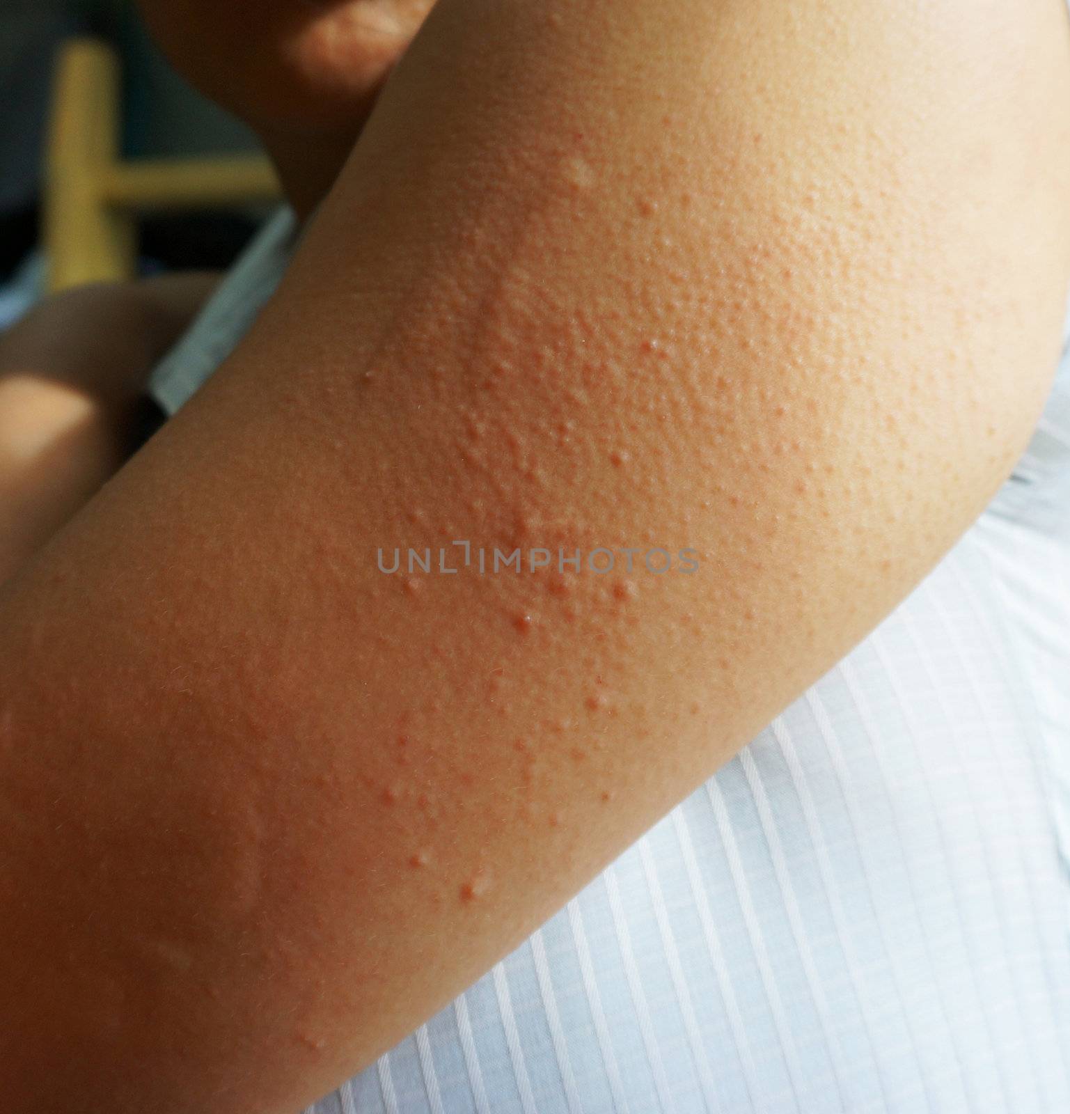 Allergic rash dermatitis, itching, redness, at the arm skin of patient.                            