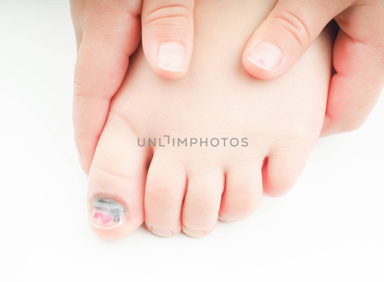 Little girl holding onto  her foot with an injured big toe, showing blue nail on the hallux, with a tiny bit of pink pedicure left