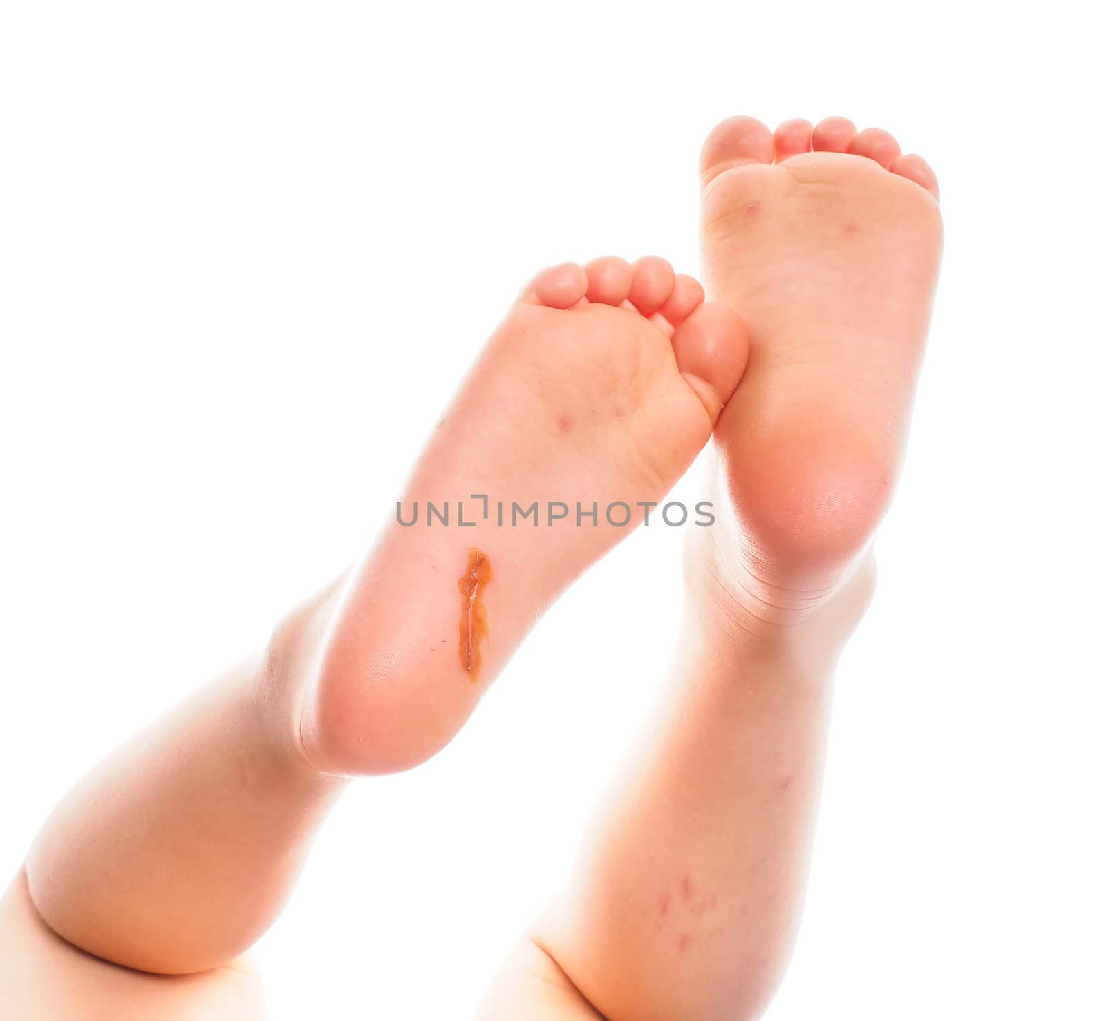 Child showing feet with a fresh wound underneath the right heel towards white