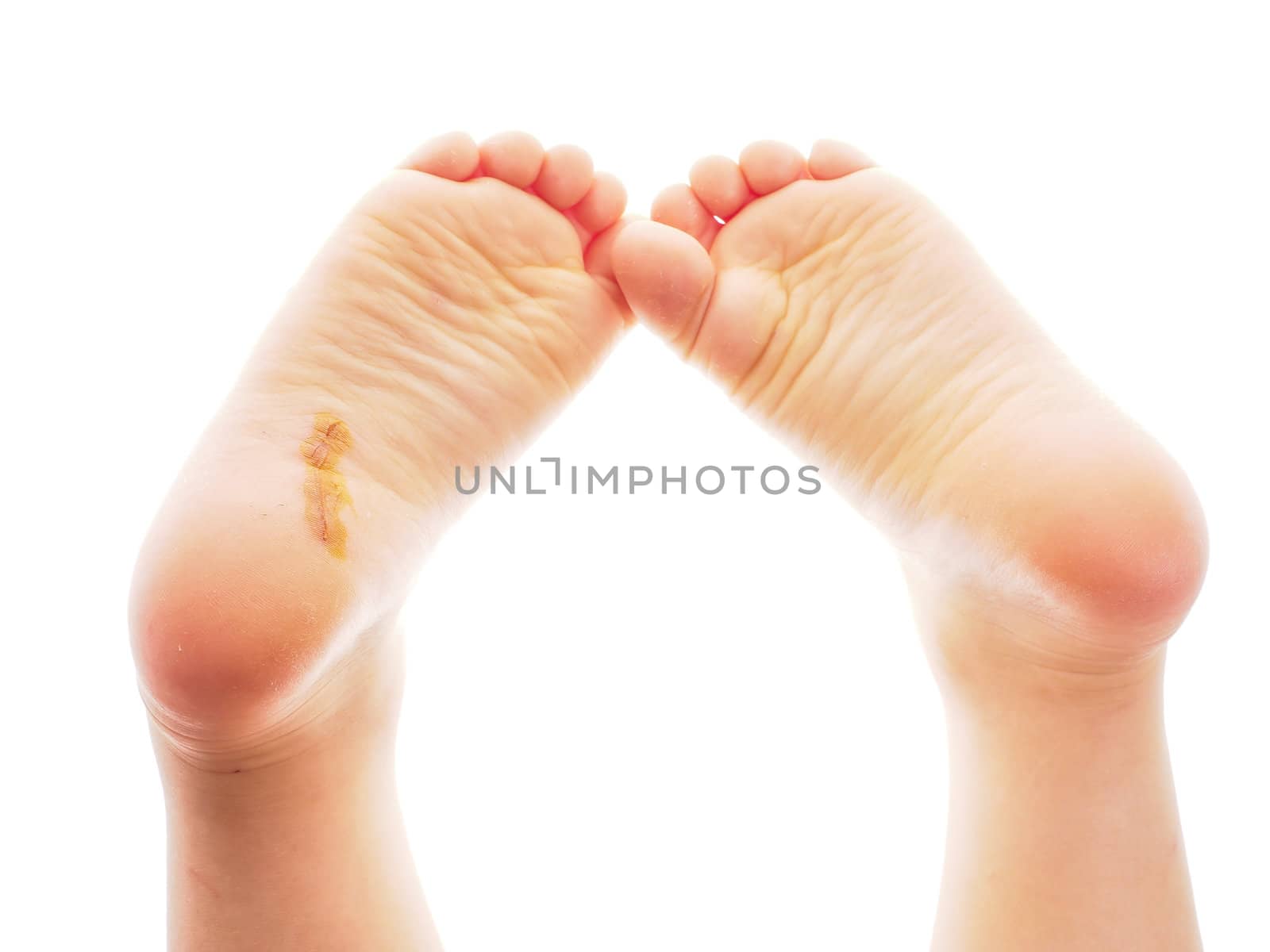 Child showing feet with a fresh wound underneath the right heel  by Arvebettum