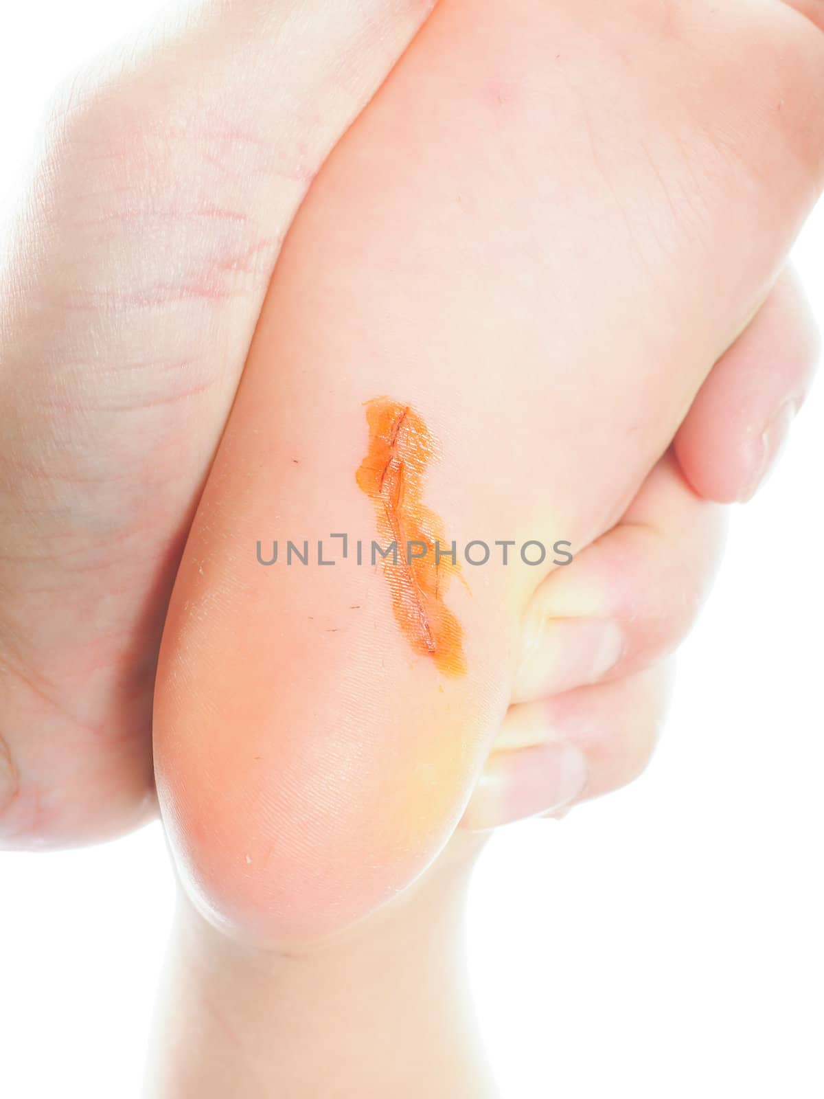 Child with a long cut under foot on heel with antiseptic, being examinated towards white