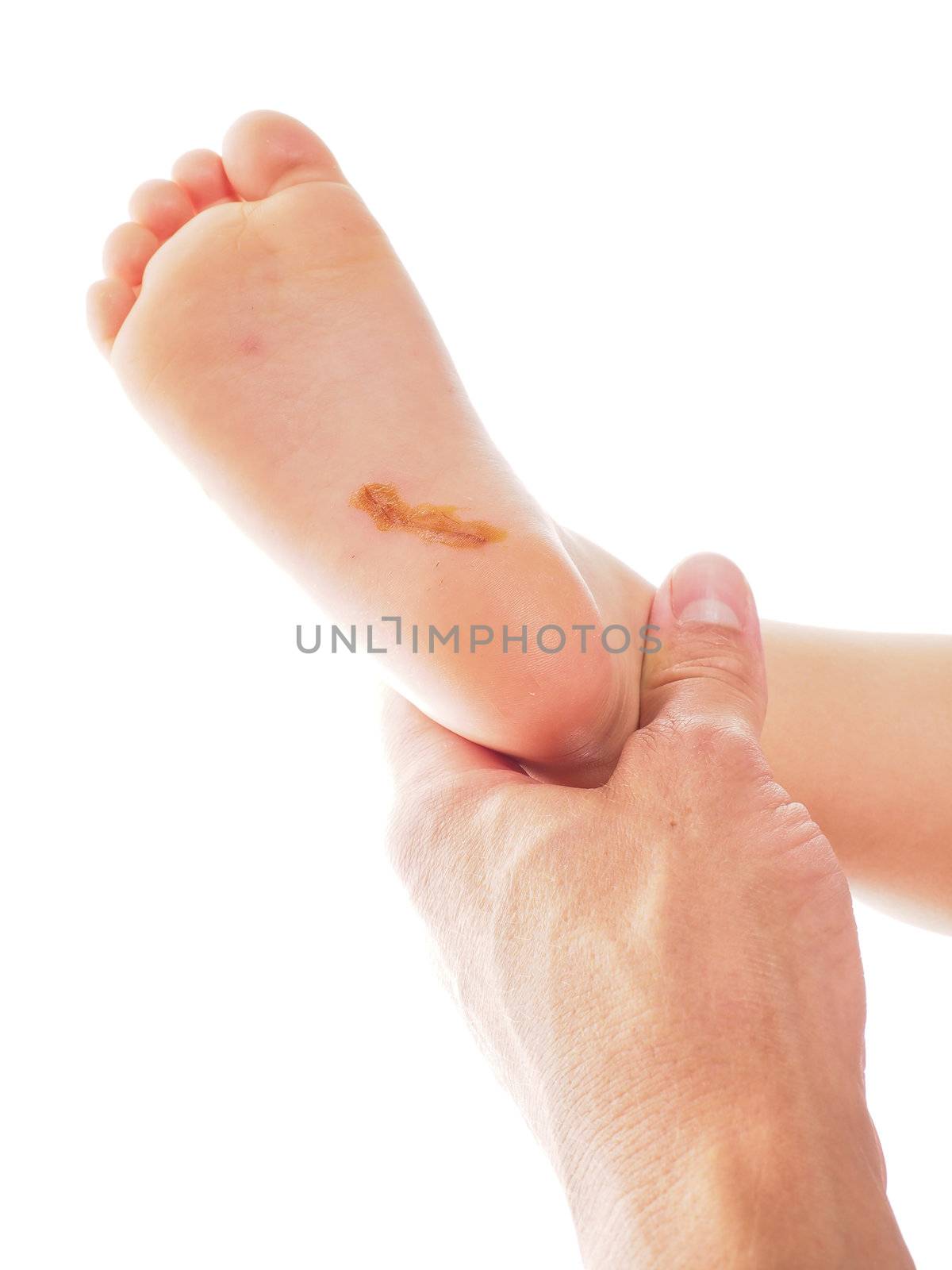 Child with a long cut under foot on heel, being examinated towards white
