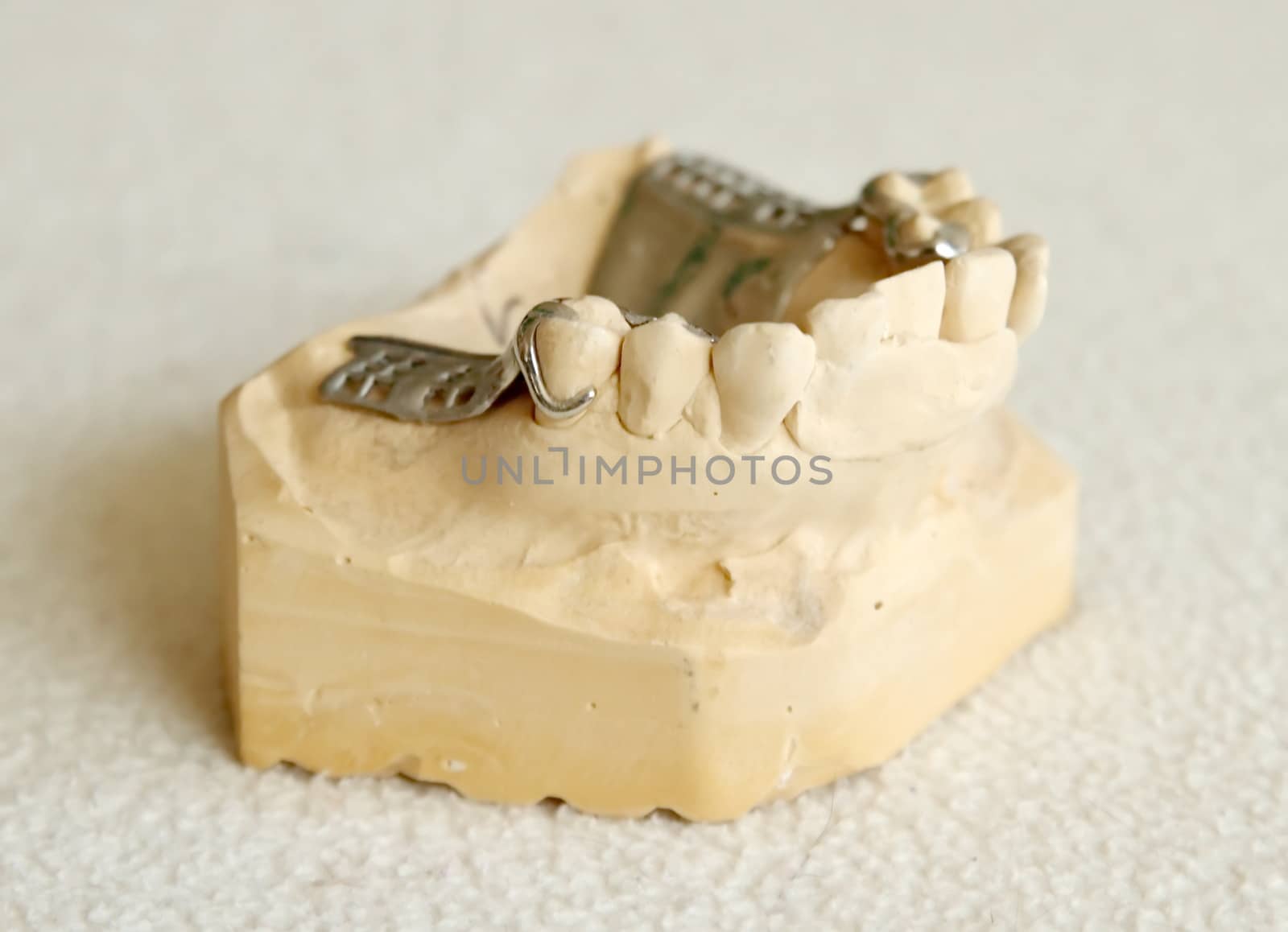 Metal framework for partial denture by Elenaphotos21