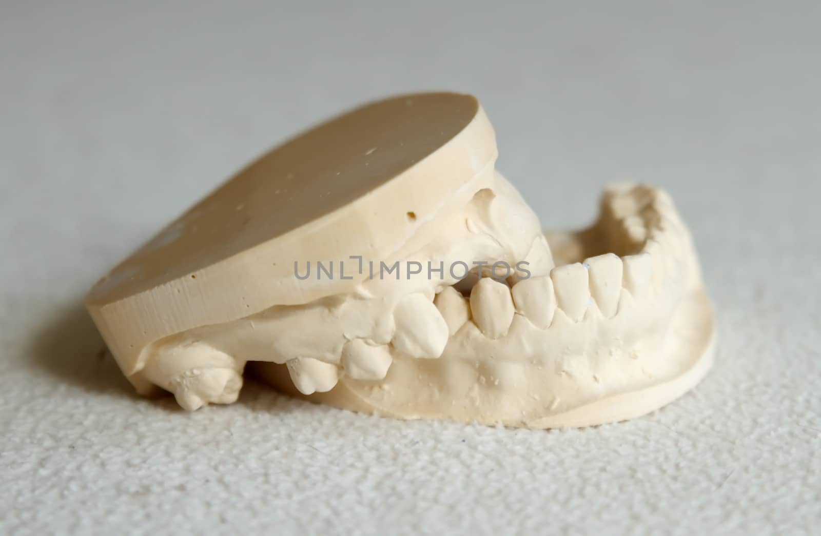 Dental gypsum model mould of teeth in plaster