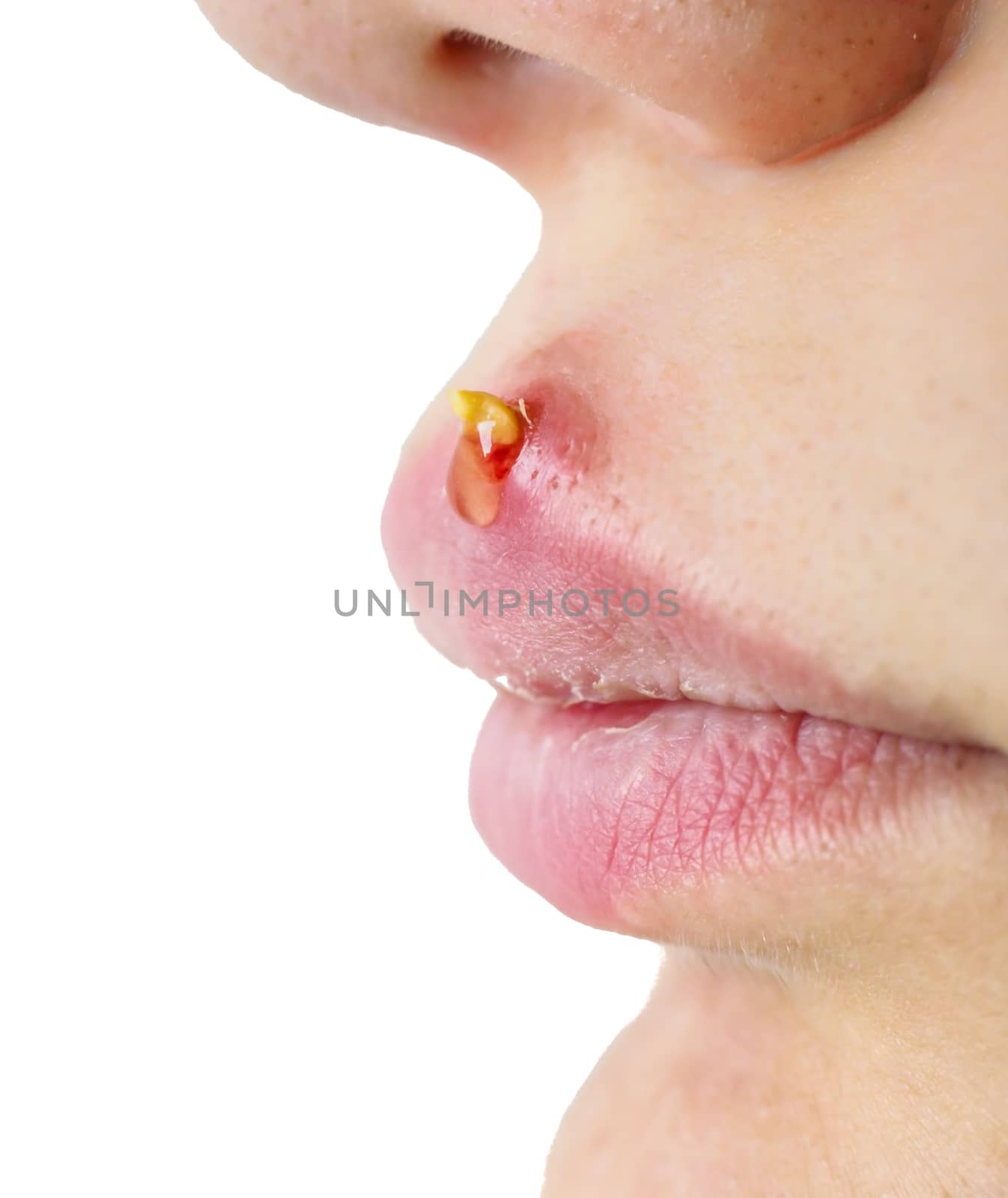 Closeup of woman with huge acne outbreak on upper lip by Arvebettum