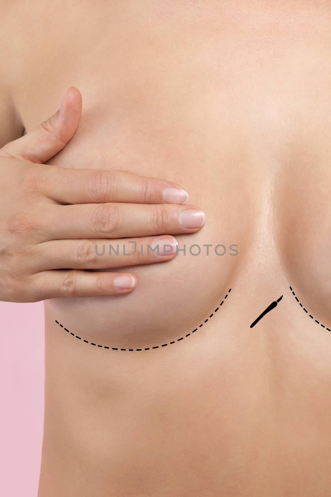 Beautiful woman touching breast with plastic surgery marks. Aesthetic medicine and plastic surgery.