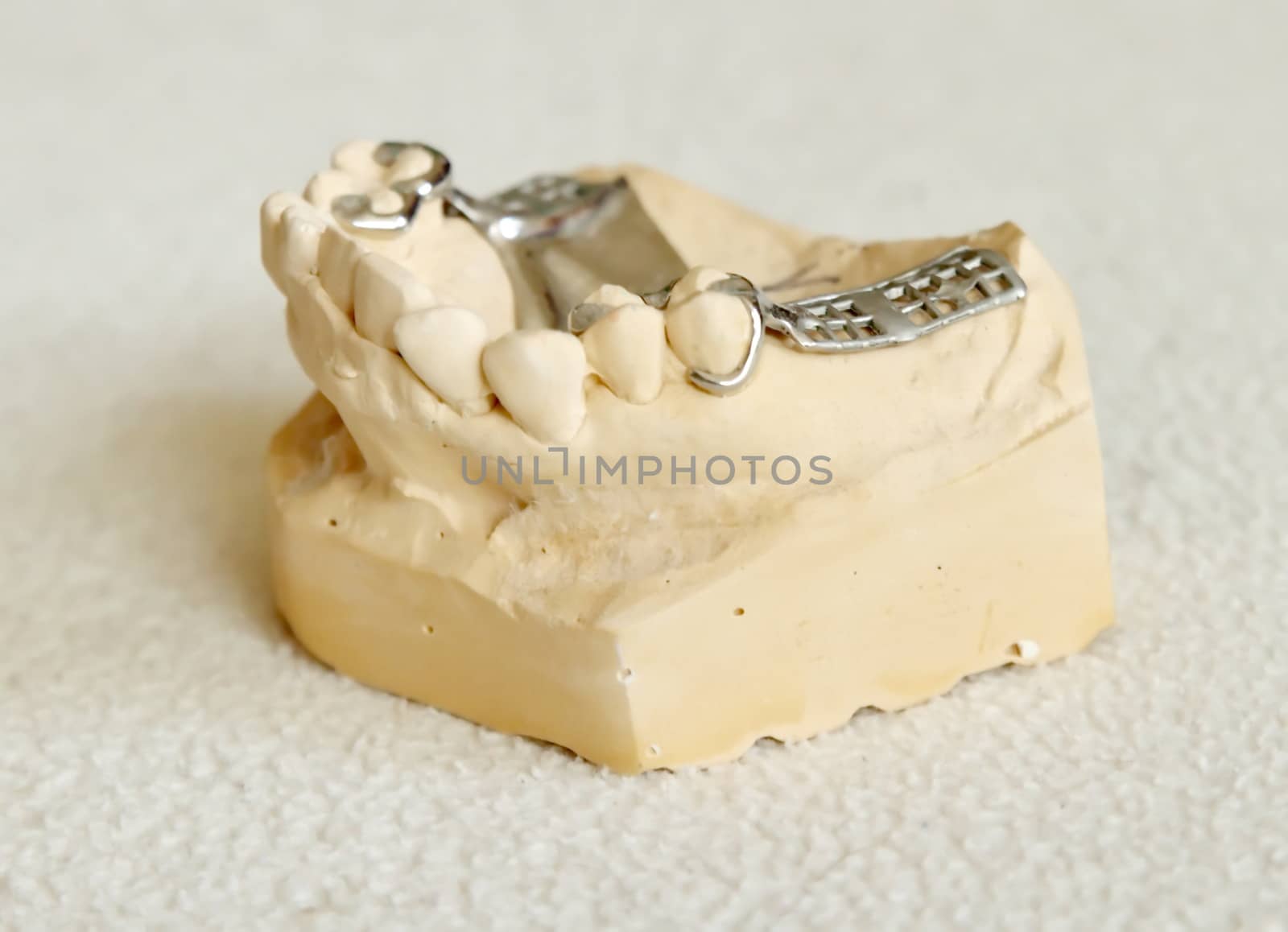 Metal framework for partial denture by Elenaphotos21
