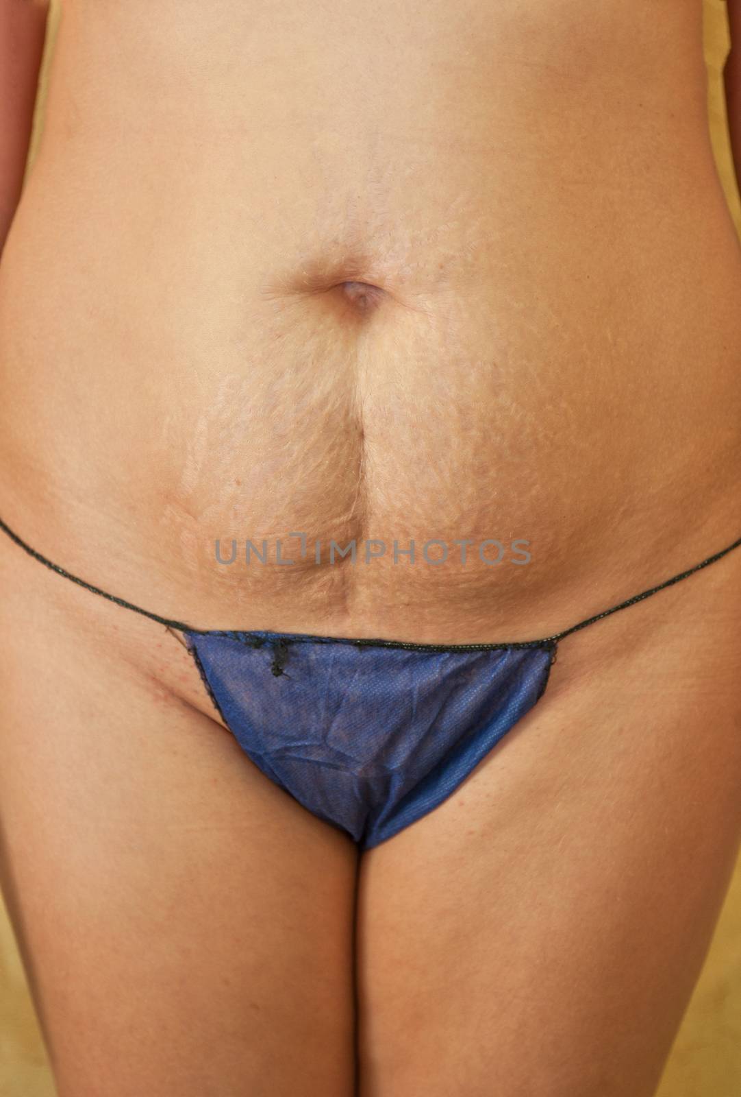 Women with skin stretch closeup