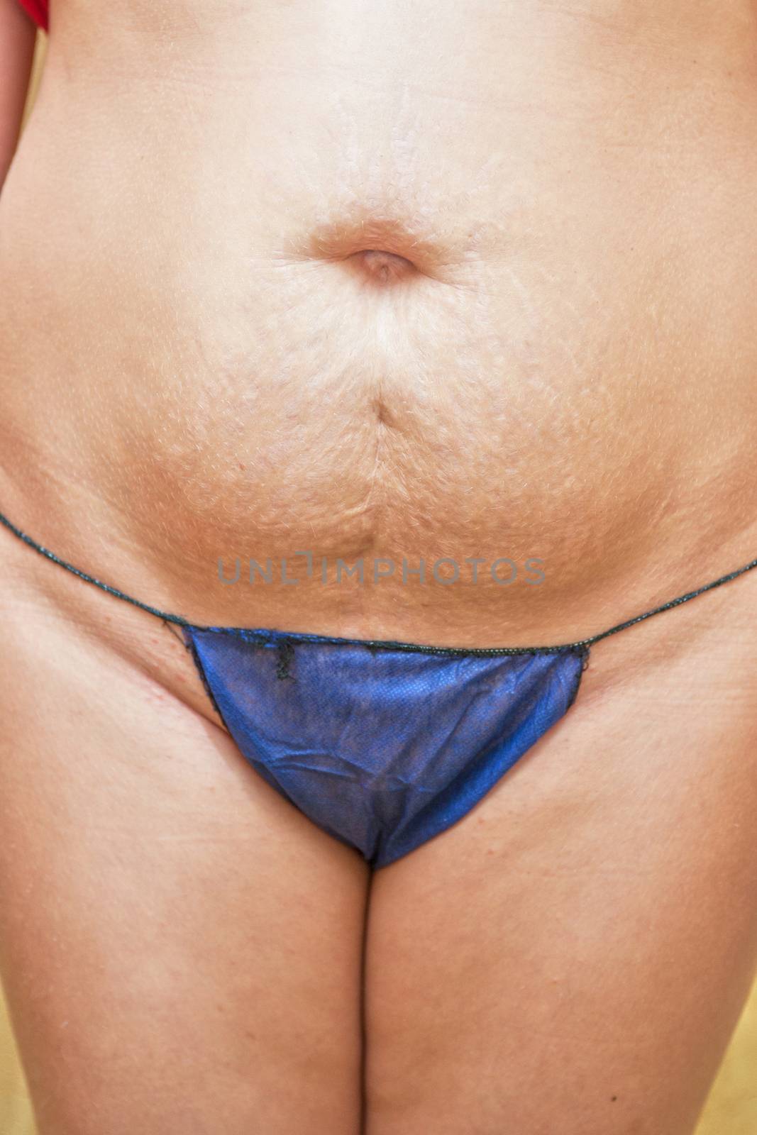 Women with skin stretch closeup