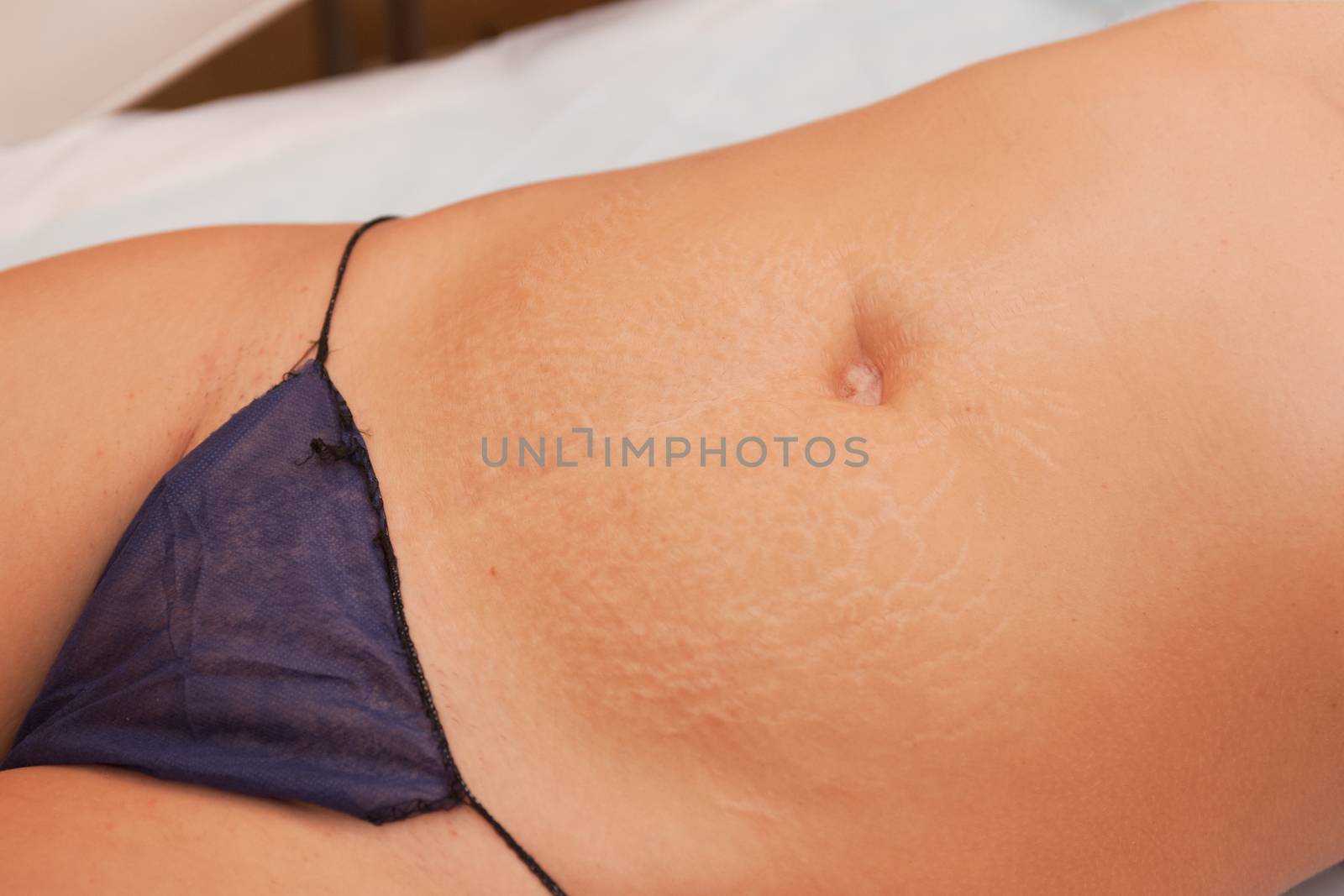 Women with skin stretch closeup