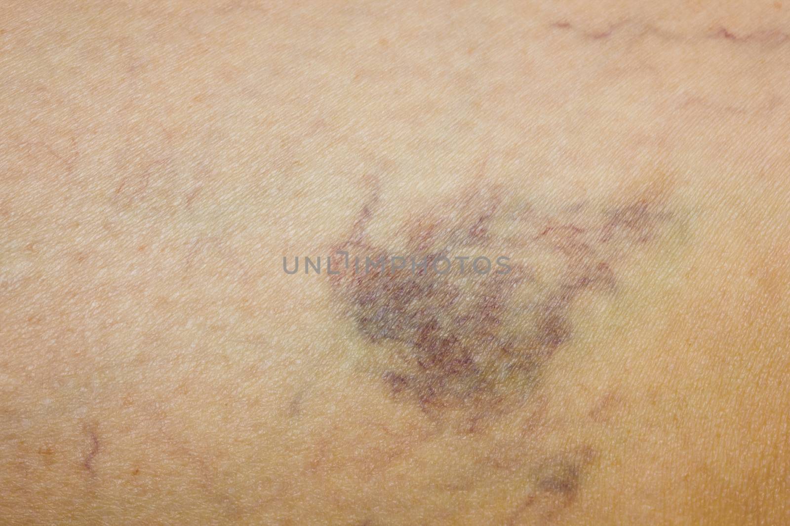 Leg with varicose veins