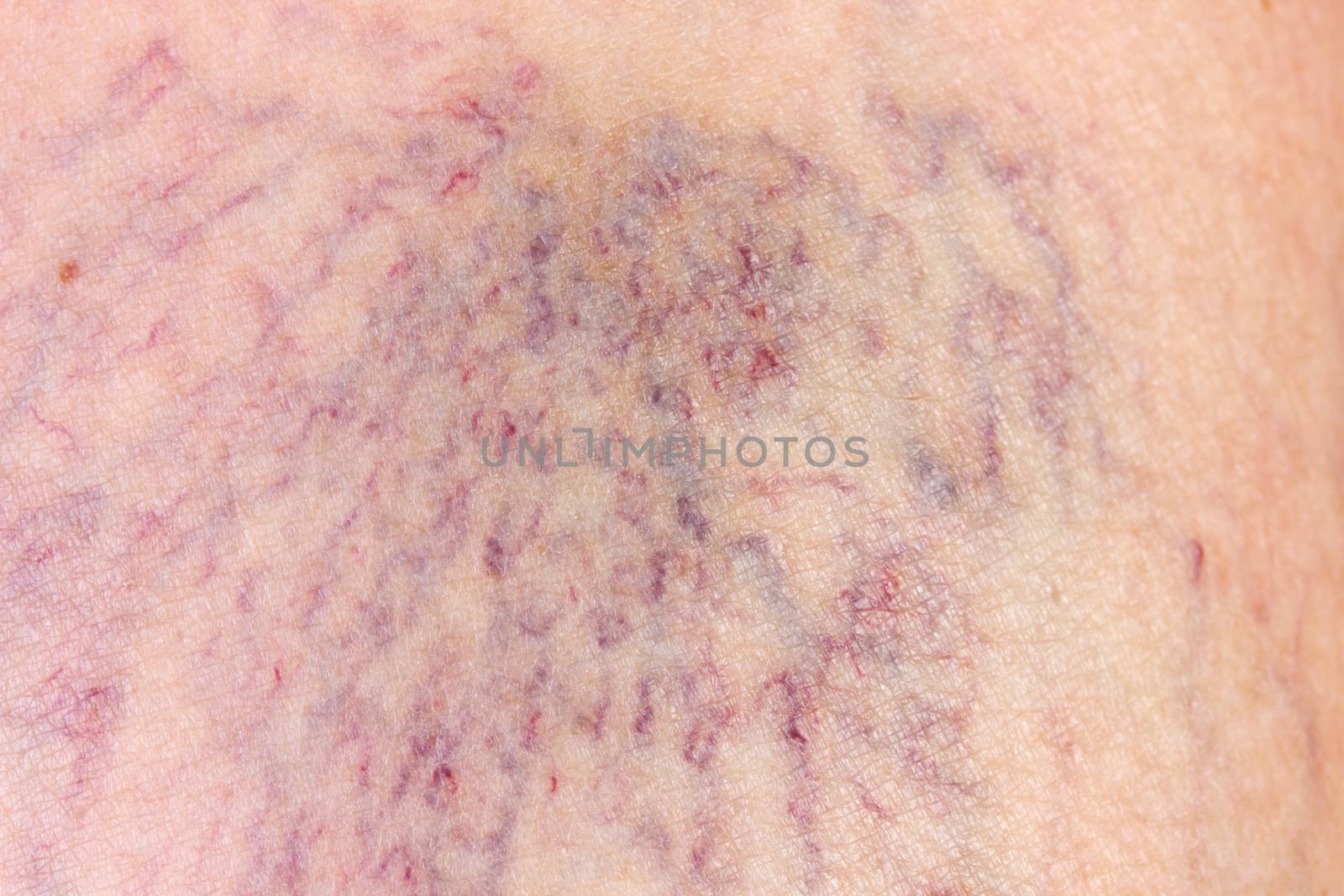 Close-up of dermis with varicose veins