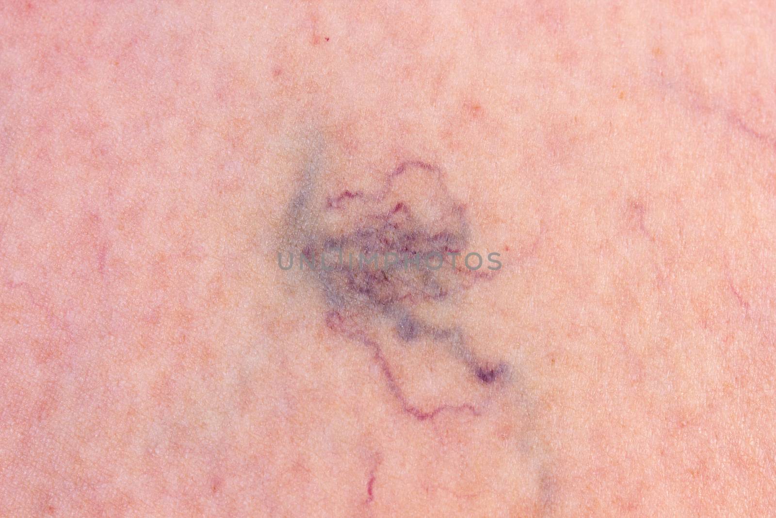Dermis with varicose veins by gwolters