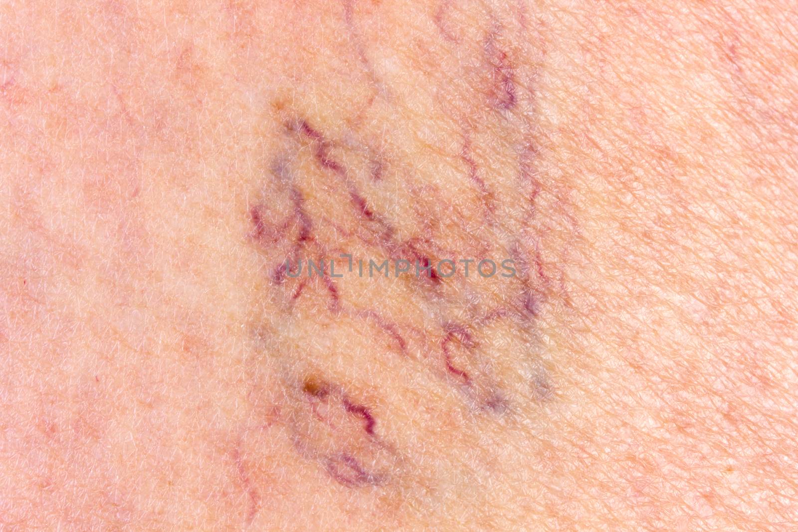 Close-up of leg with varicose veins by gwolters