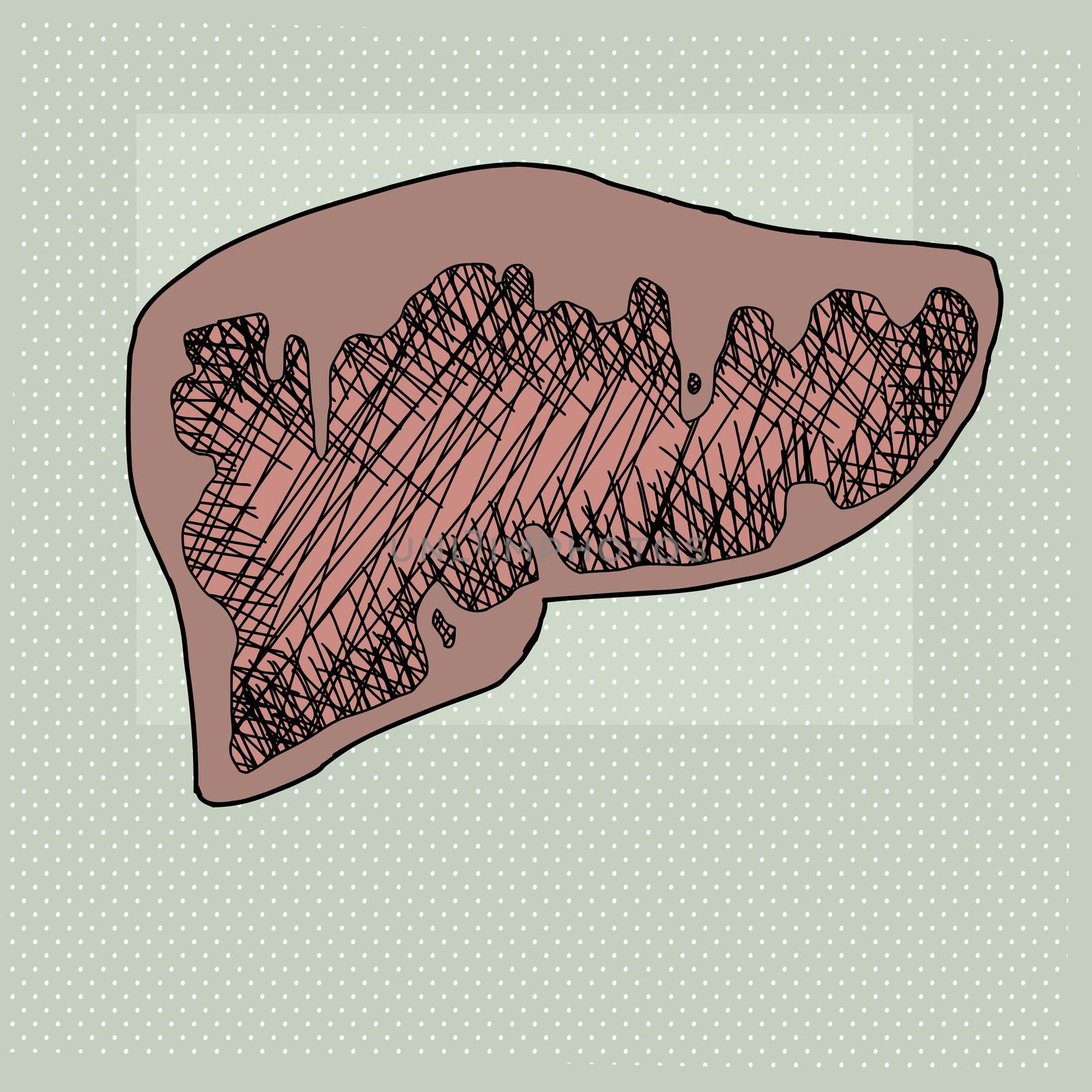 Cartoon cross section of diseased human liver organ