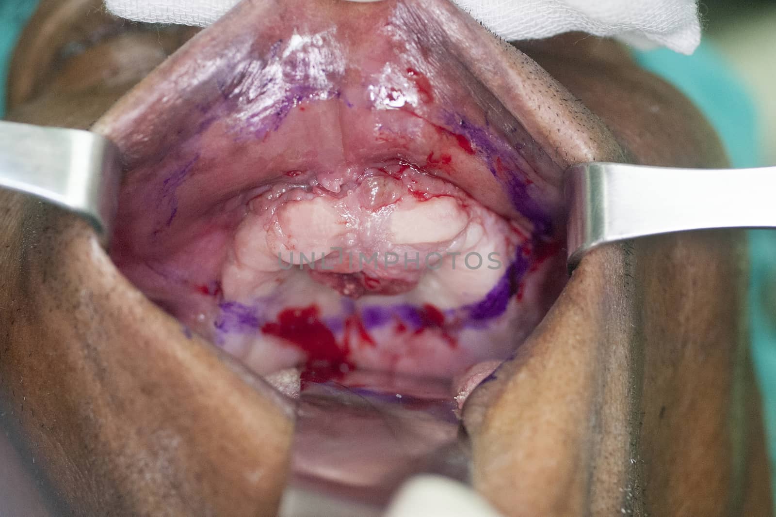 Oral Surgery Reconstruction