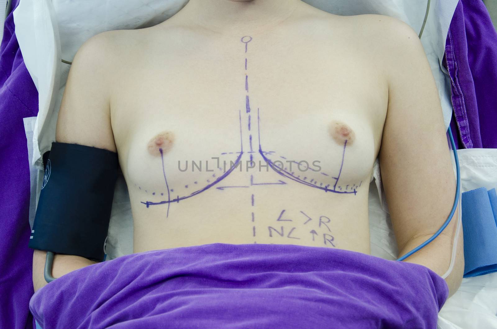 Plastic surgery doctor draw line on patient breast augmentation implant