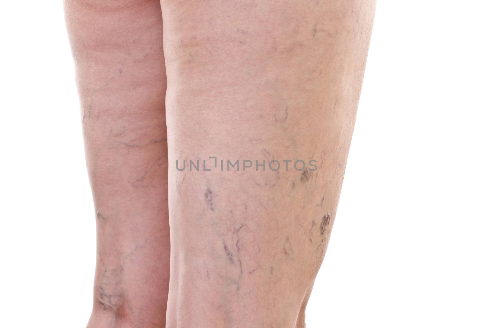 Legs with varicose veins