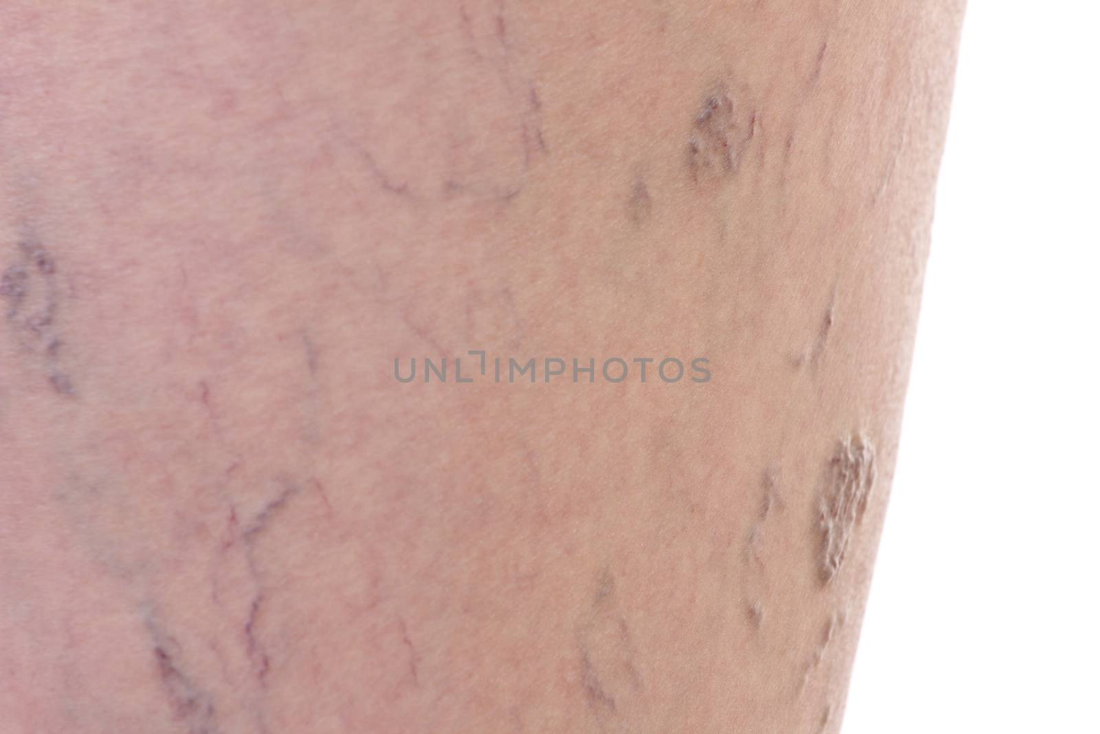 Close-up of dermis with varicose veins