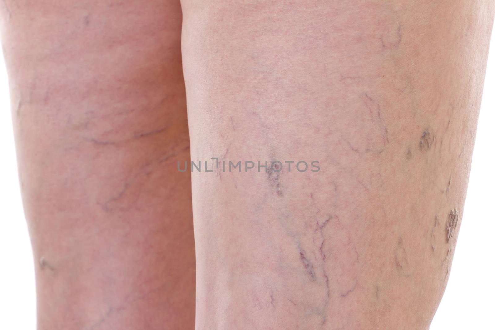 Close-up of legs with varicose veins