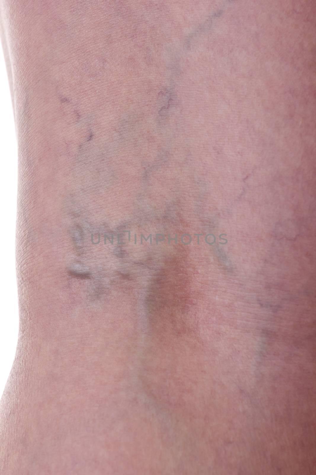 Leg with varicose veins