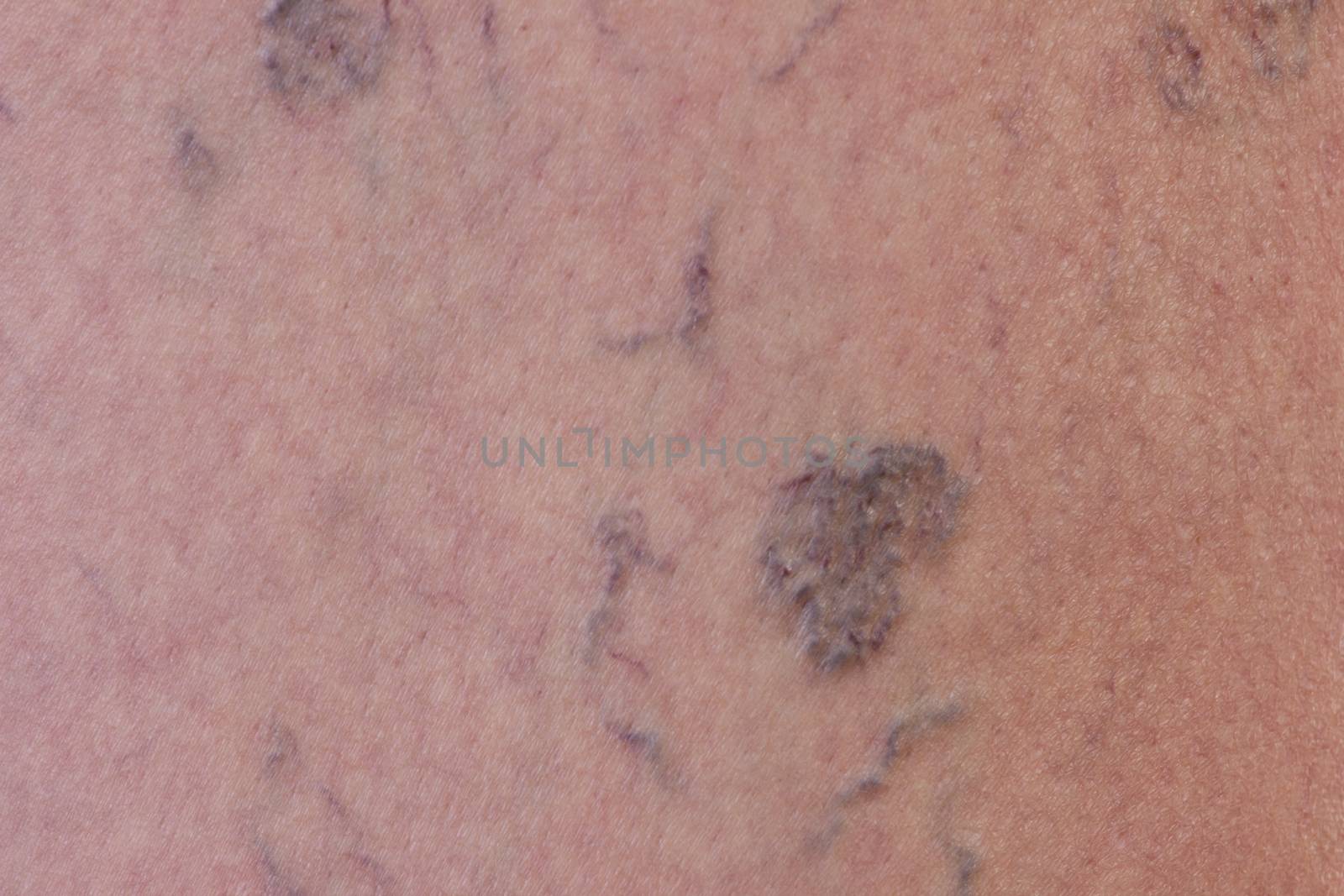 Close-up of varicose veins by gwolters