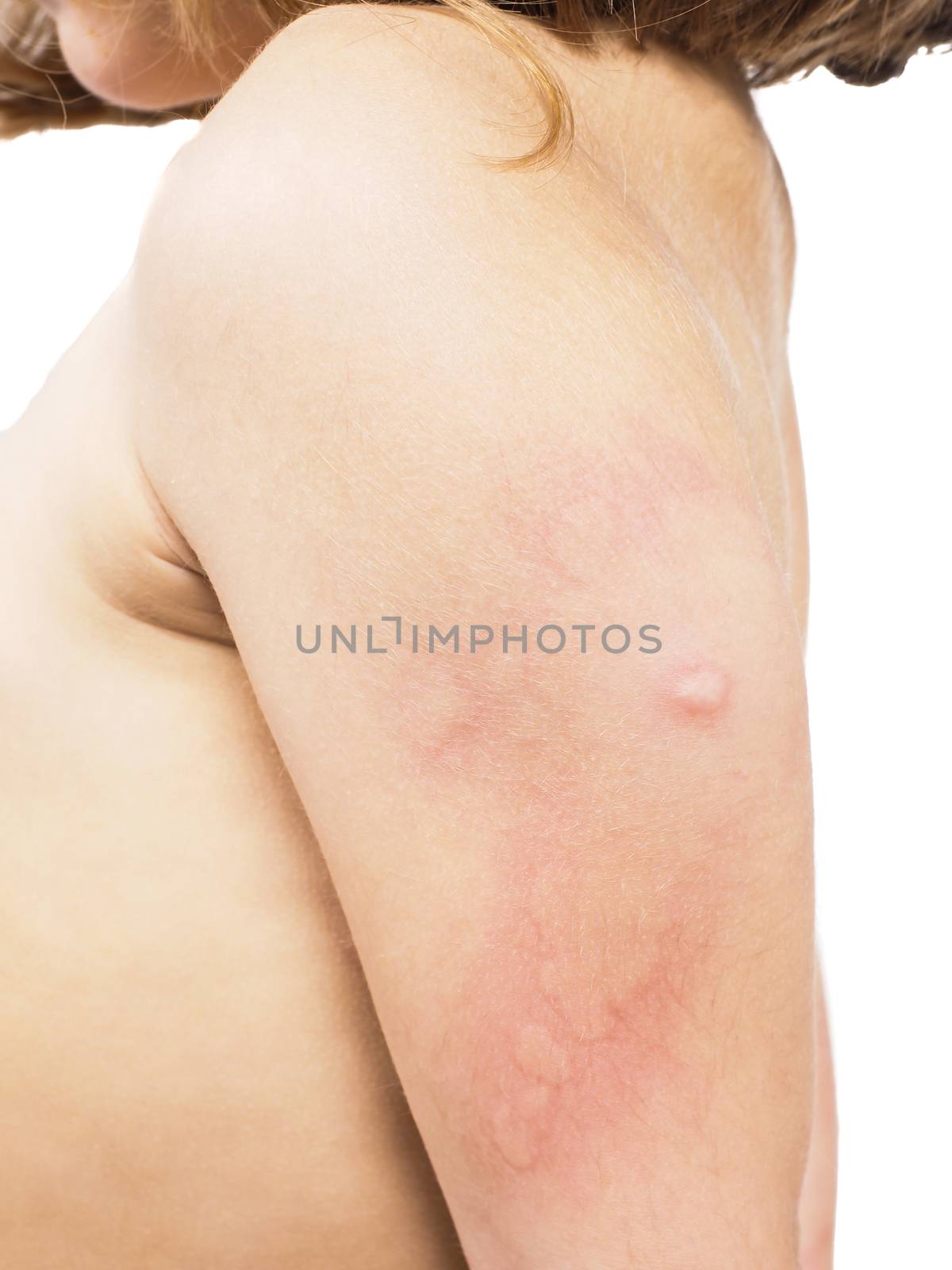 Child with hive, rash, or some skin abnormality on left arm under shoulder by Arvebettum