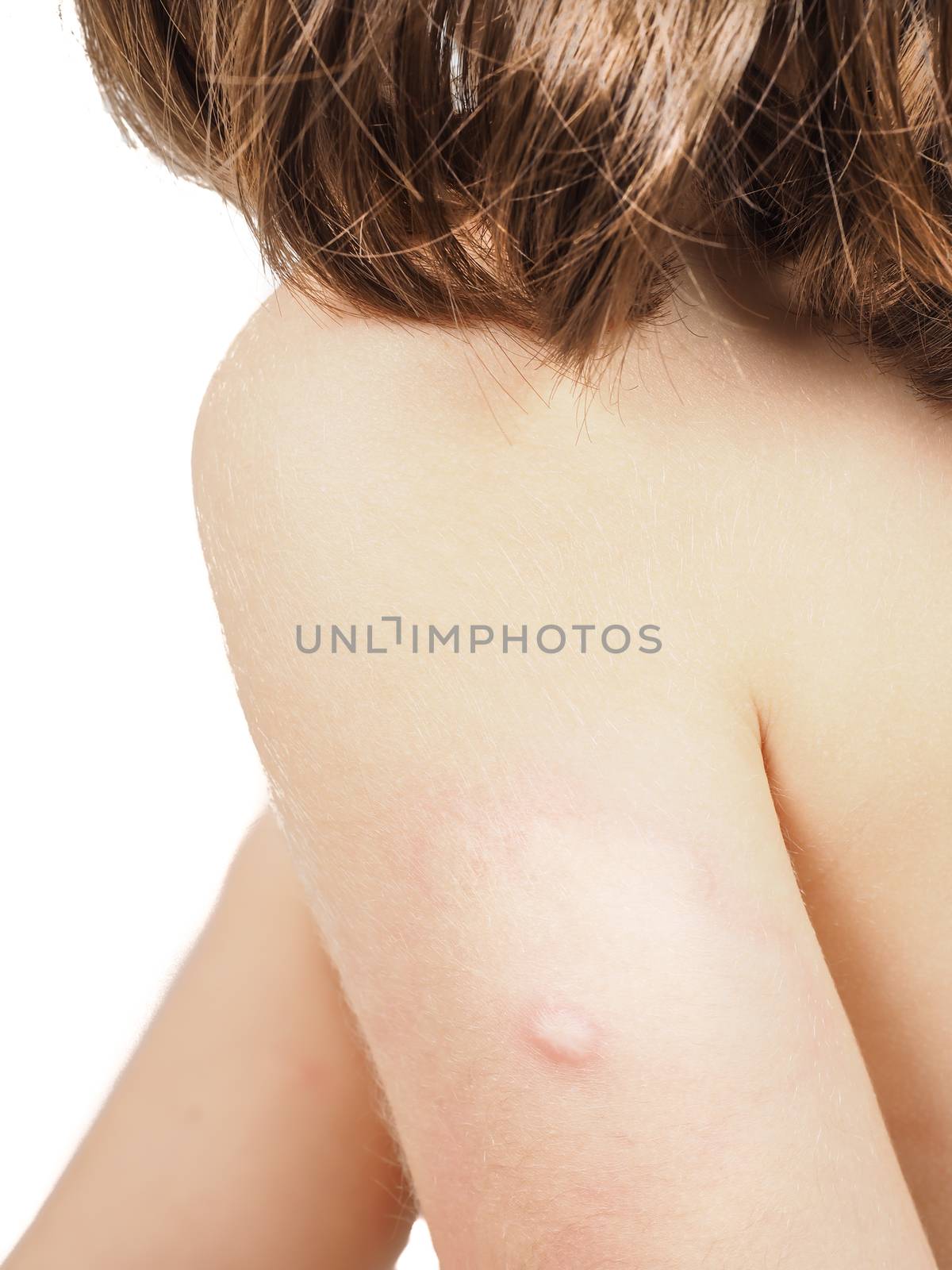 Child with hive, rash, or some skin abnormality by Arvebettum