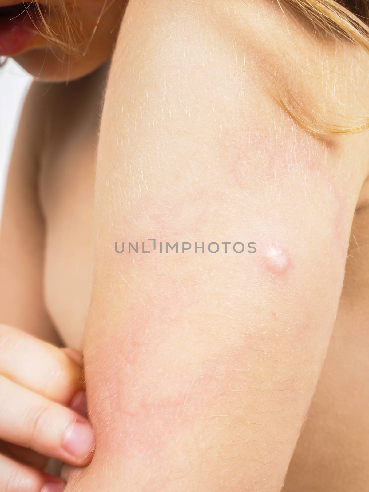 Child with hive, rash, or some skin abnormality on left arm under shoulder