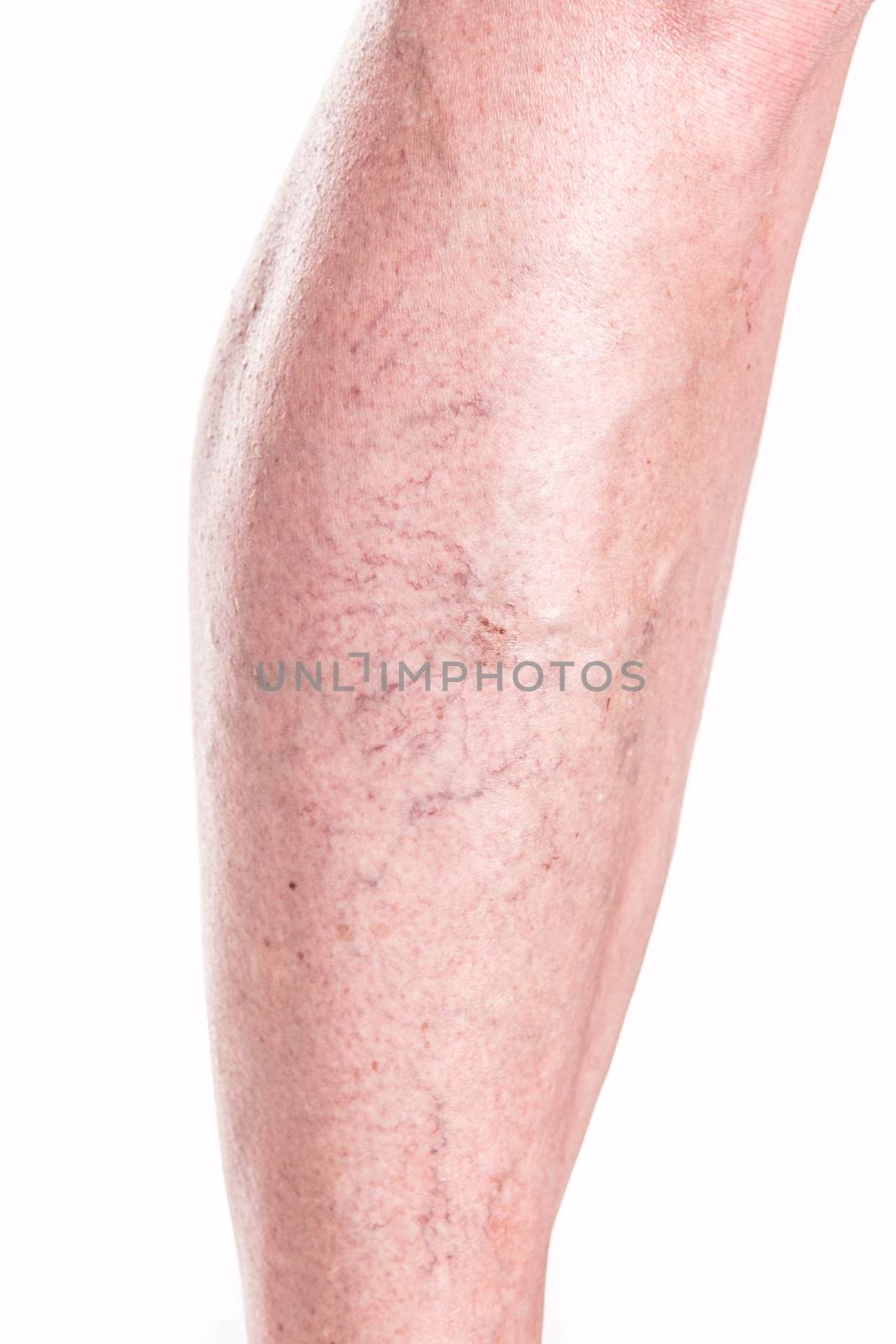 Varicose Veins on the legs of woman - studio shoot 
