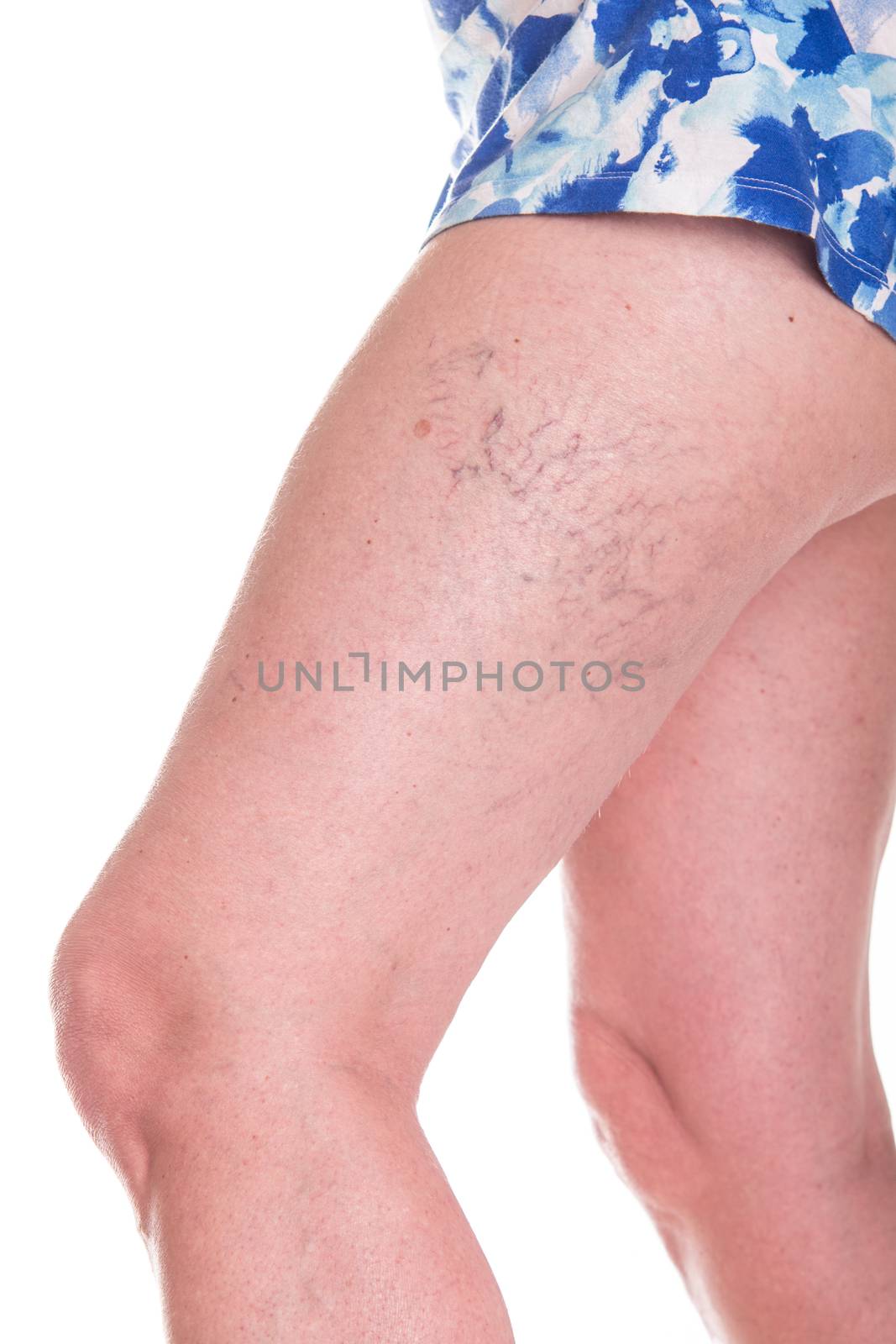 Human spaider veins on the legs of woman - studio shoot 