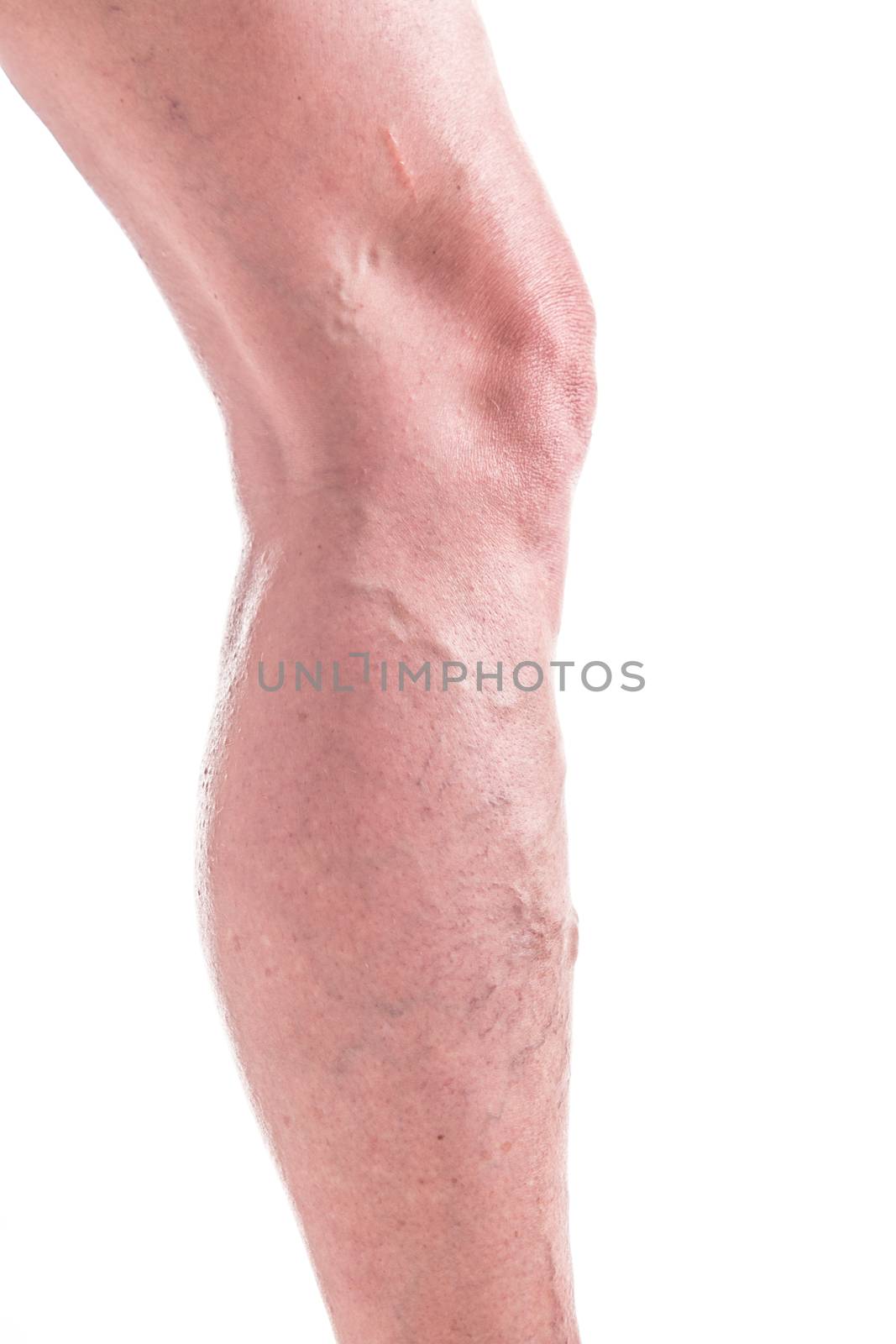 Varicose Veins on the legs of woman by MichalLudwiczak