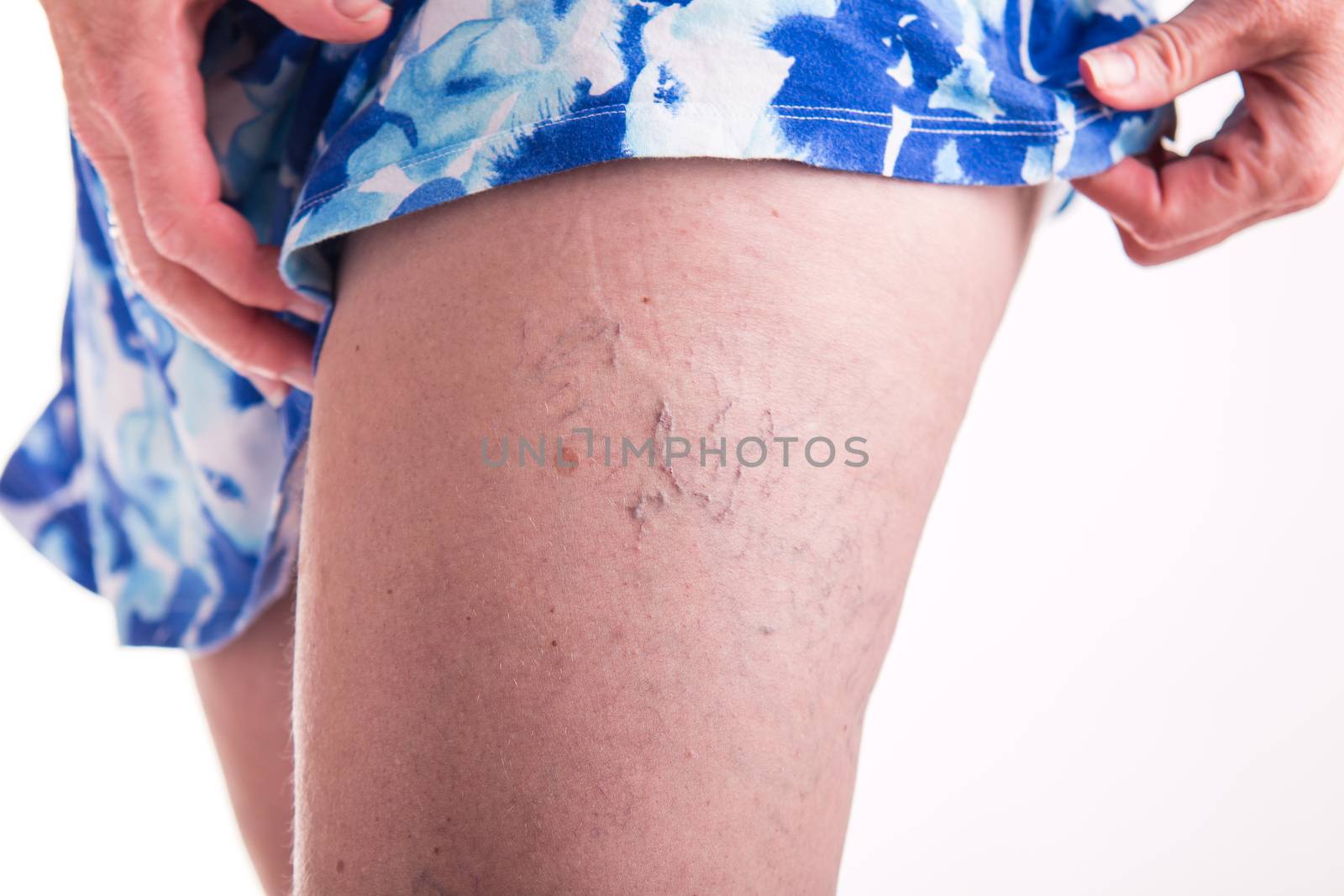 Human spaider veins on the legs of woman by MichalLudwiczak