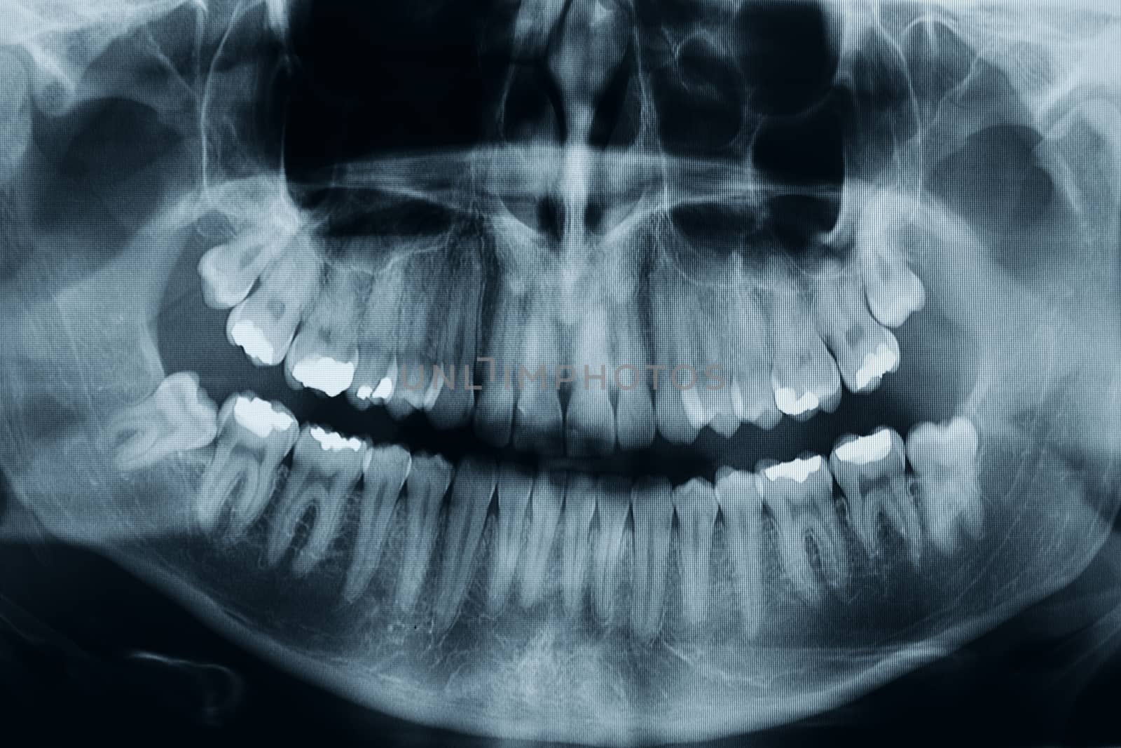 Dental xray by photosampler