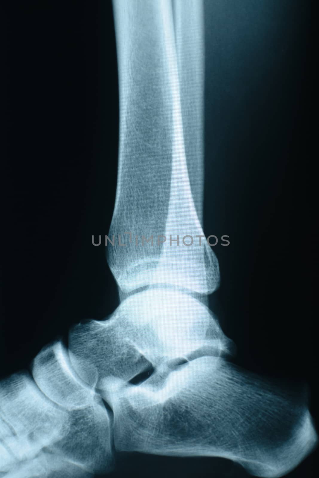 Ankle xray by photosampler