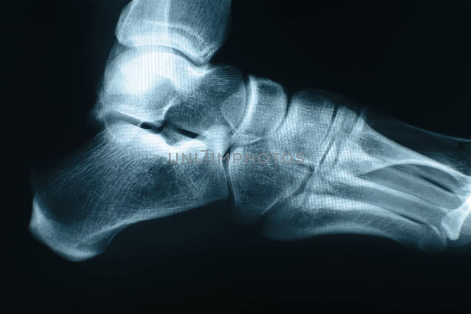 Xray shot of right foot made in a hospital.