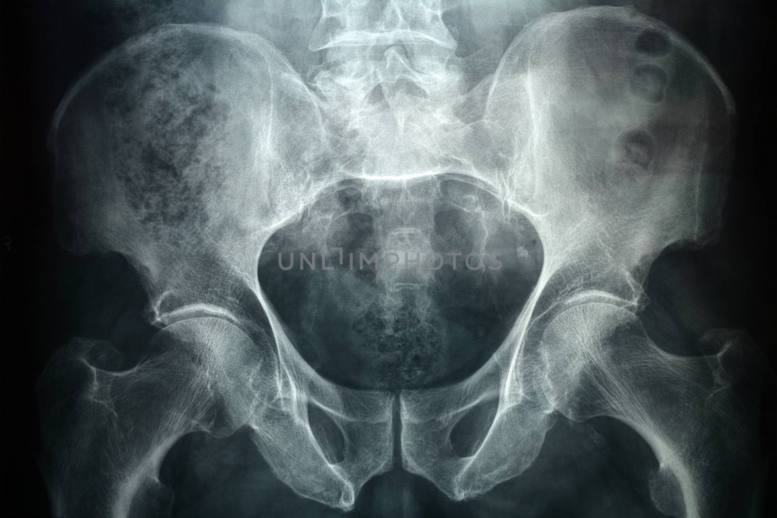 Xray of a male pelvic, it's a high resolution 24 mp photo not a scan.