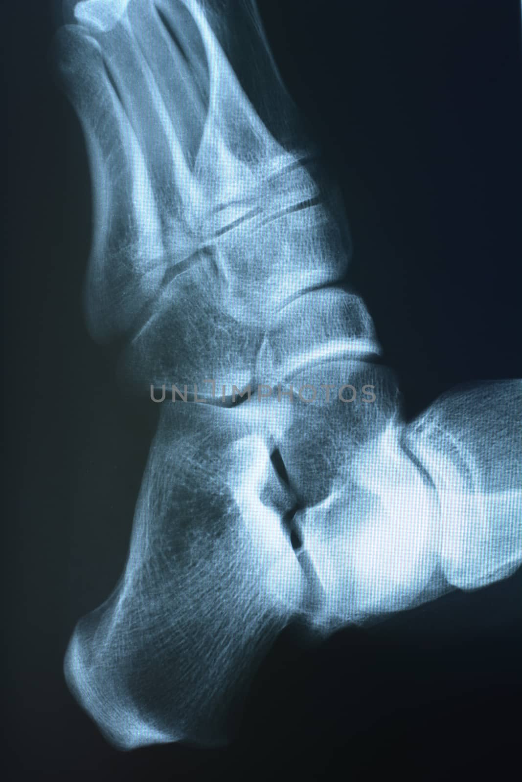 Xray shot of right foot made in a hospital.