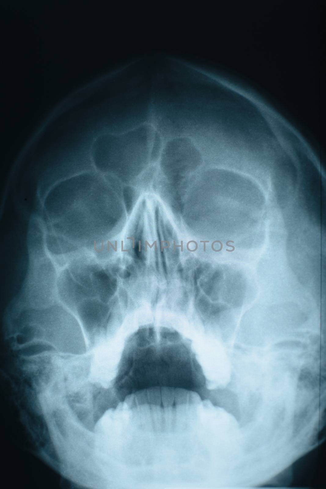 Female head xray, made in a hospital.