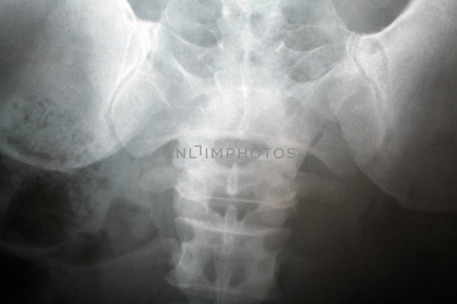 X-ray of the spinal column by Portokalis